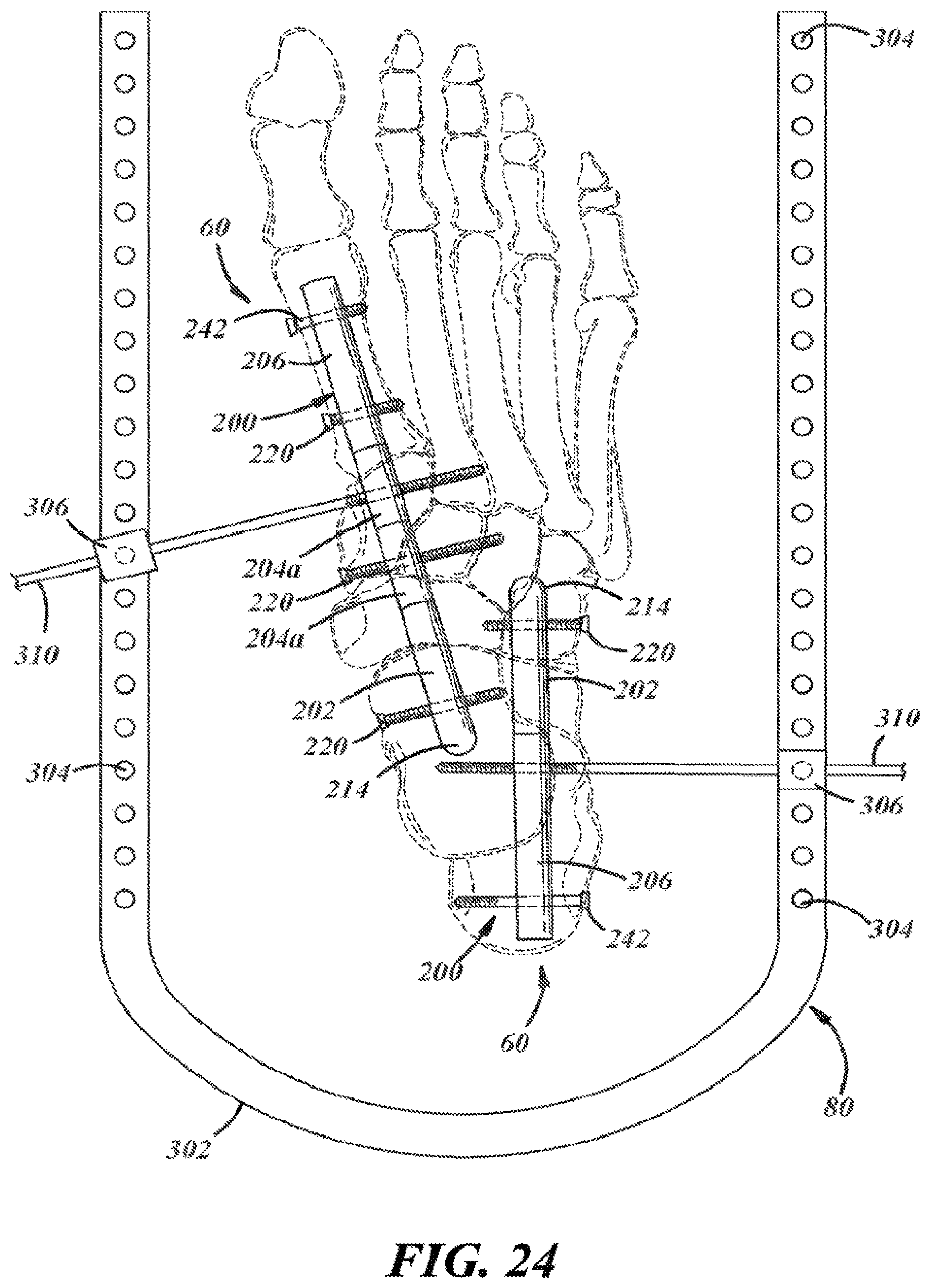 Patent US12396757 Figure 15 – Implants and methods for treating Charcot foot and other conditions