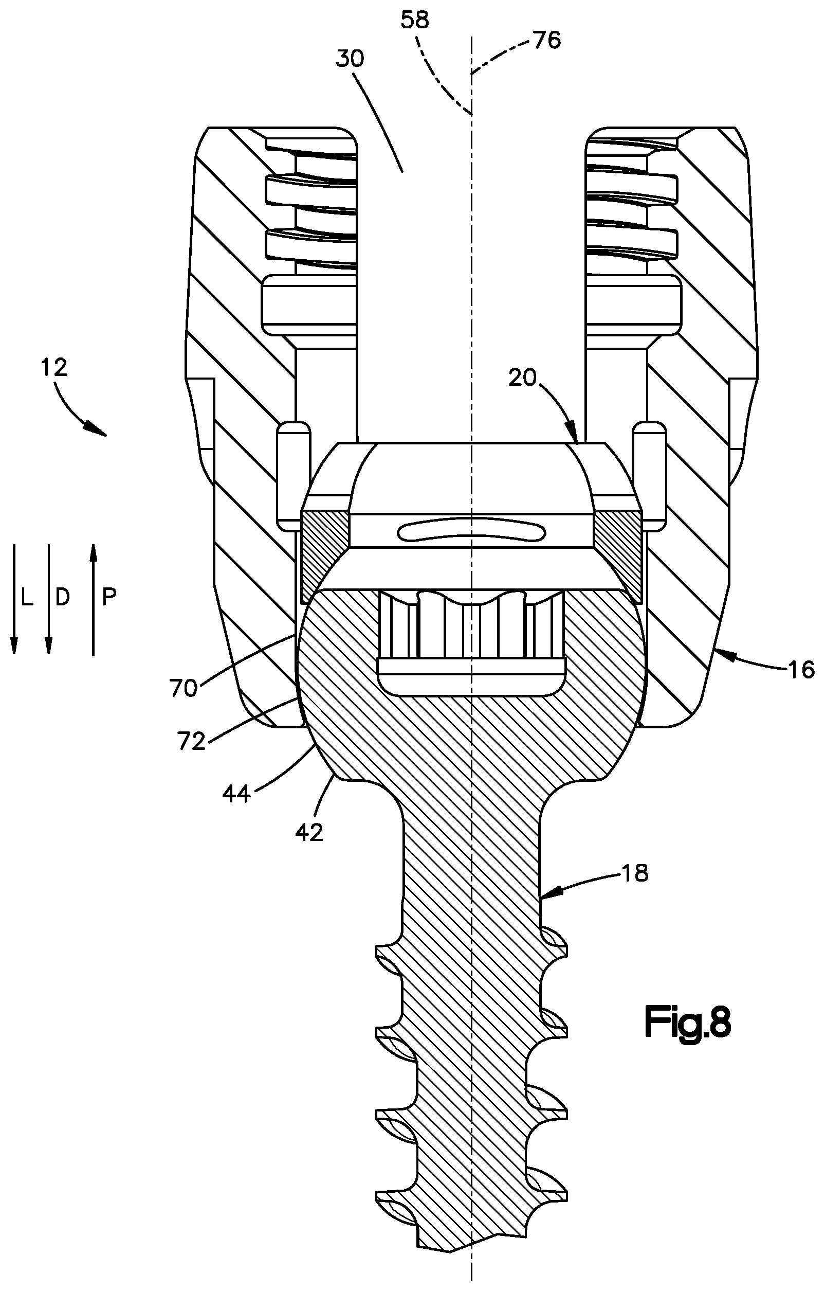 Patent US12396758 Figure 5 – Polyaxial bone fixation element