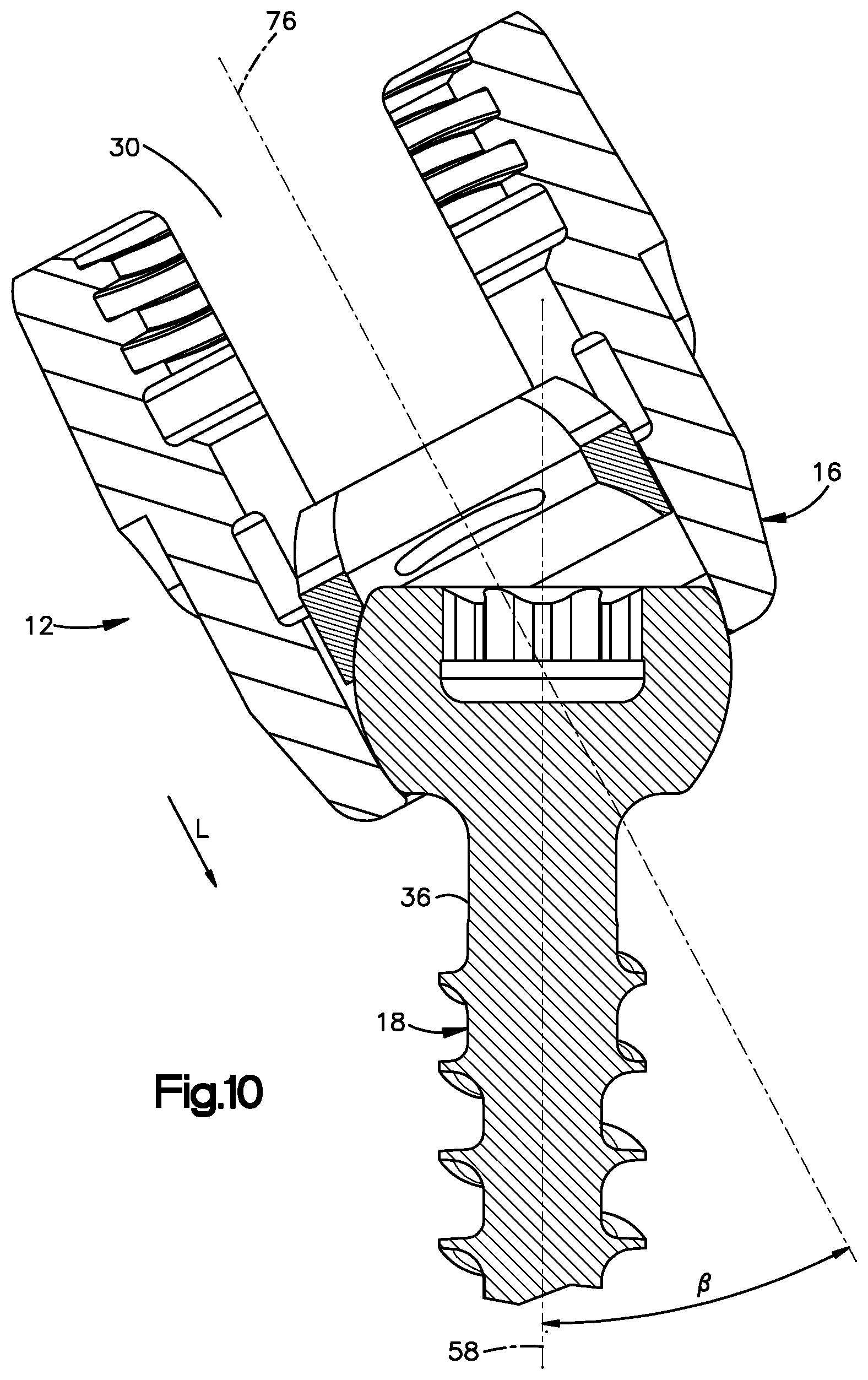 Patent US12396758 Figure 7 – Polyaxial bone fixation element