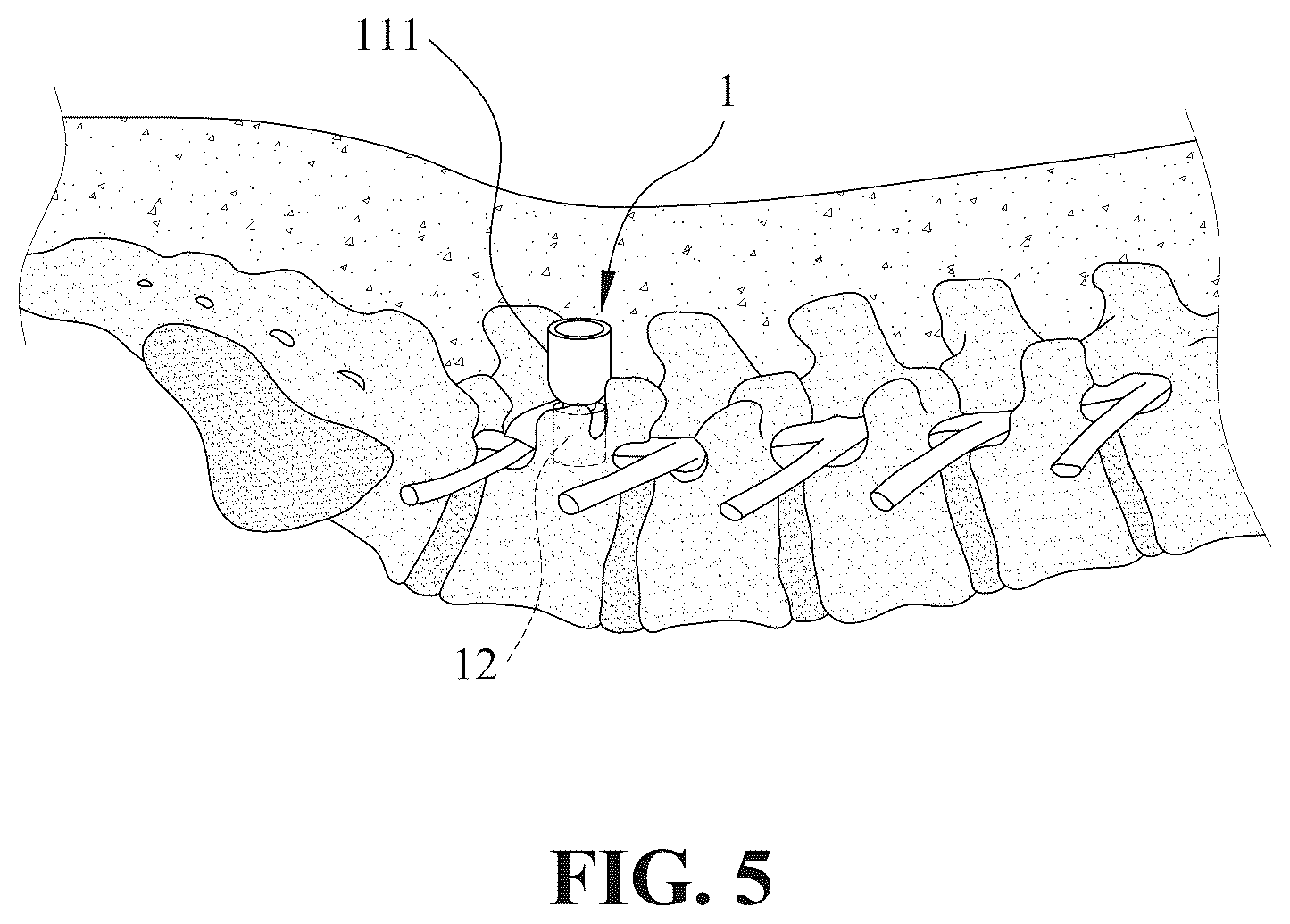 Patent US12396759 Figure 5 – Minimally invasive and endoscopic spinal fixation device