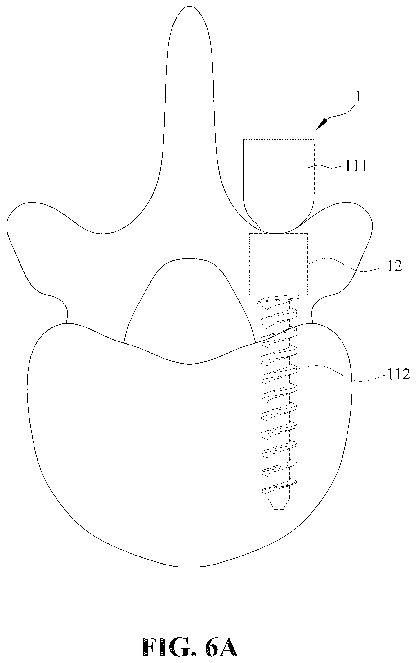 Patent US12396759 Figure 6 – Minimally invasive and endoscopic spinal fixation device
