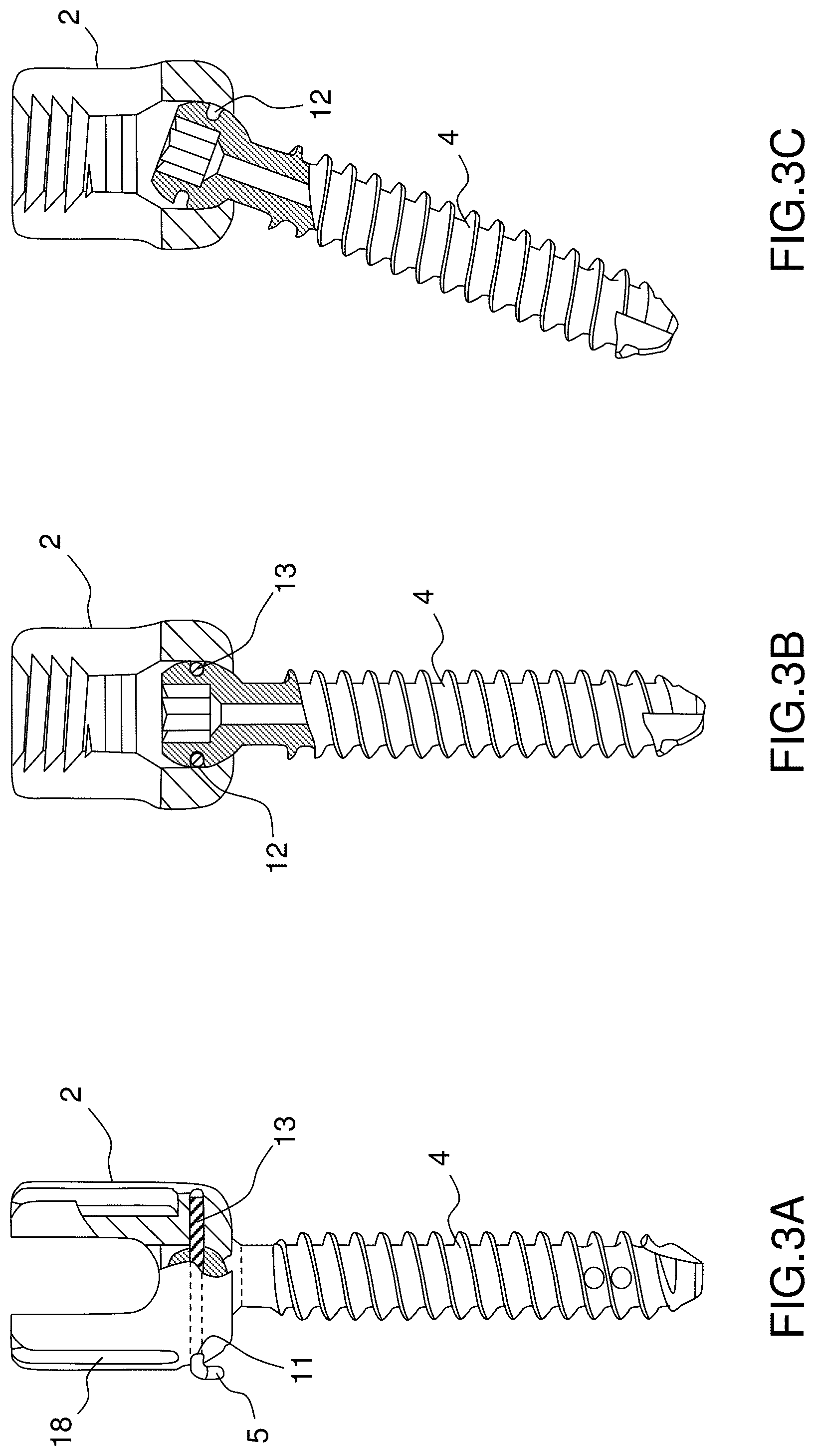 Patent US12396760 Figure 3 – Orthopedic implant kit
