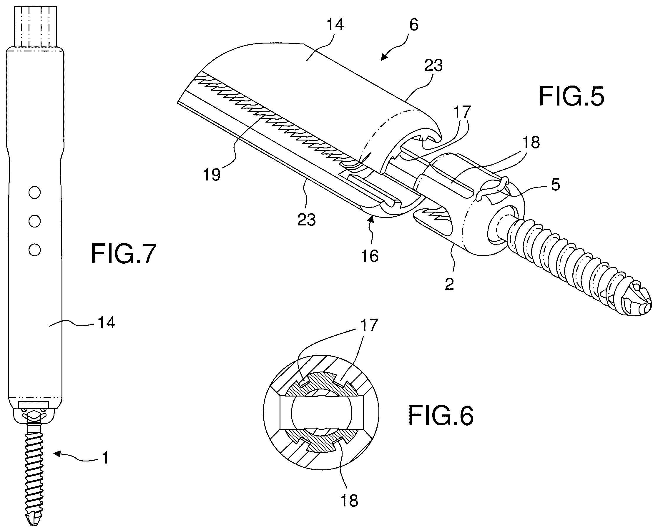 Patent US12396760 Figure 5 – Orthopedic implant kit