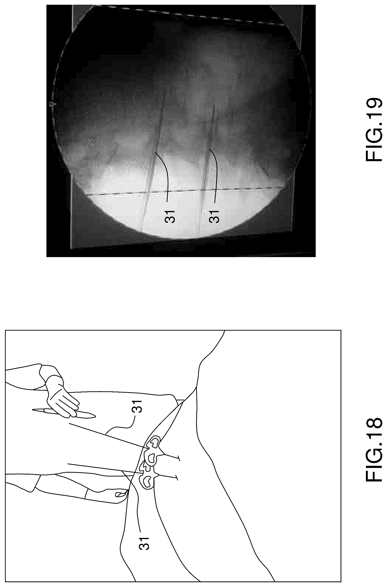 Patent US12396760 Figure 14 – Orthopedic implant kit