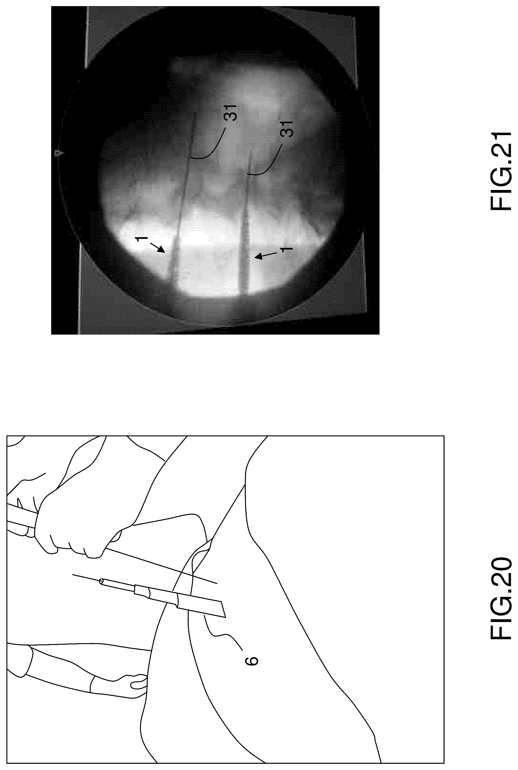 Patent US12396760 Figure 15 – Orthopedic implant kit