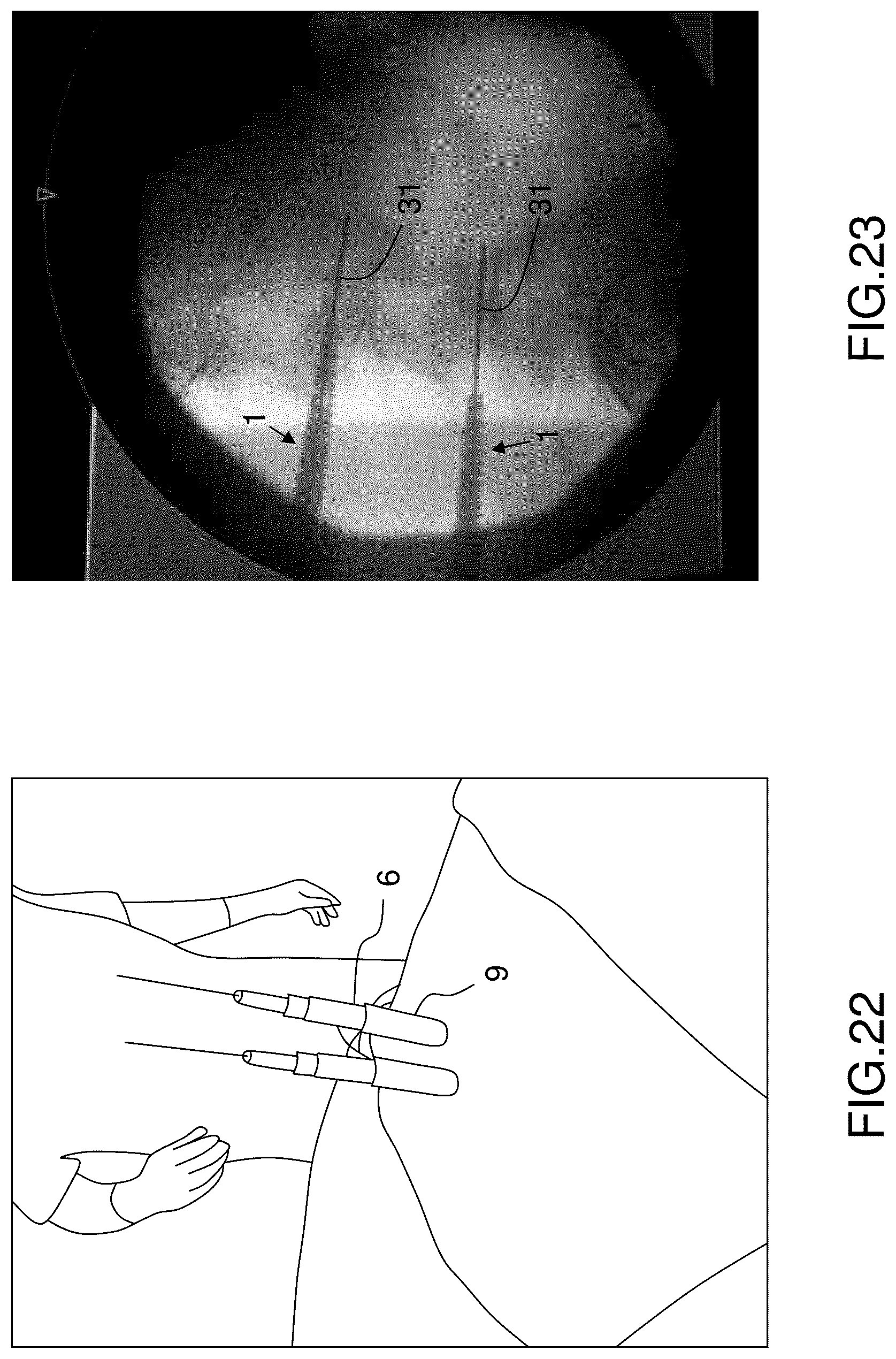 Patent US12396760 Figure 16 – Orthopedic implant kit