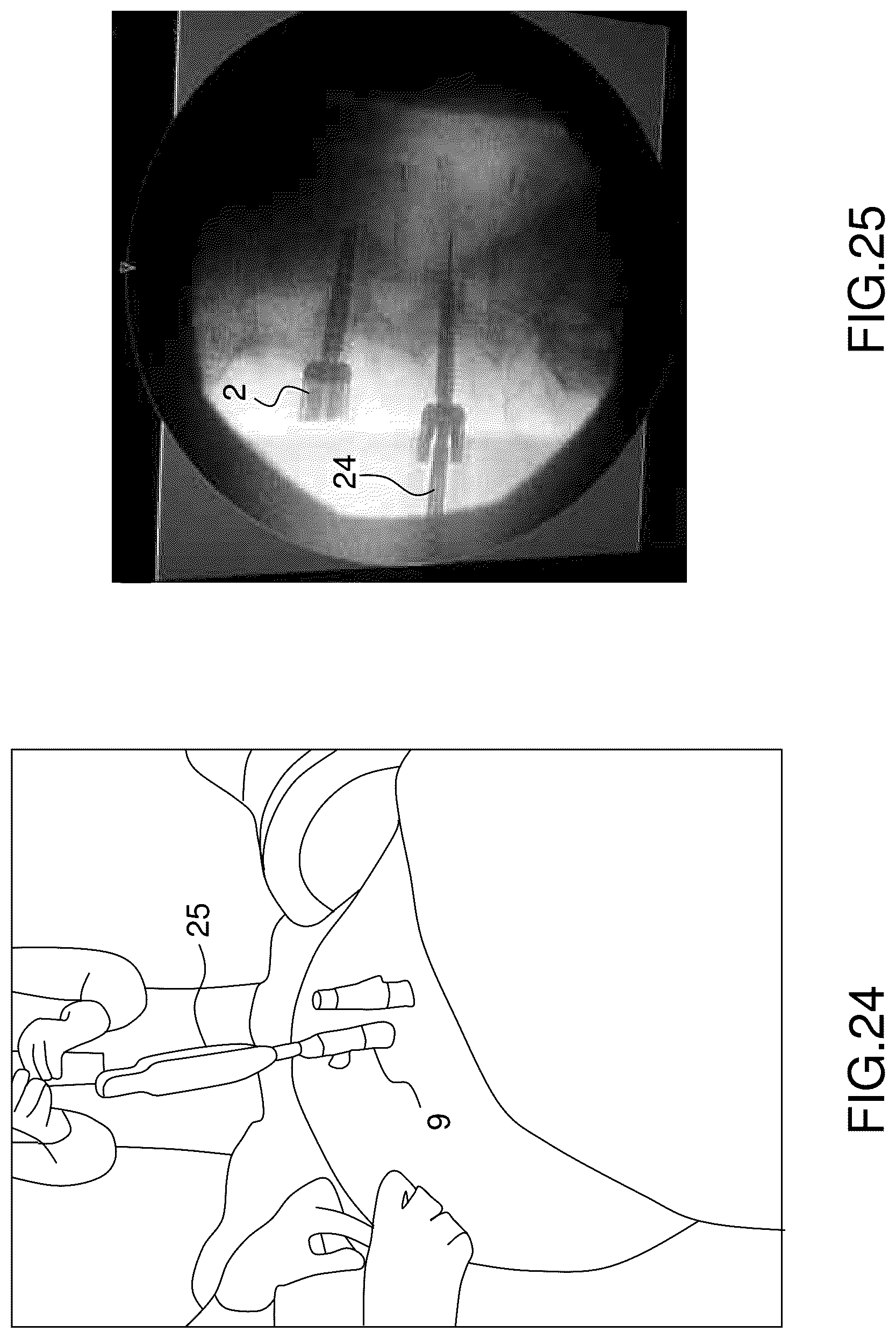 Patent US12396760 Figure 17 – Orthopedic implant kit