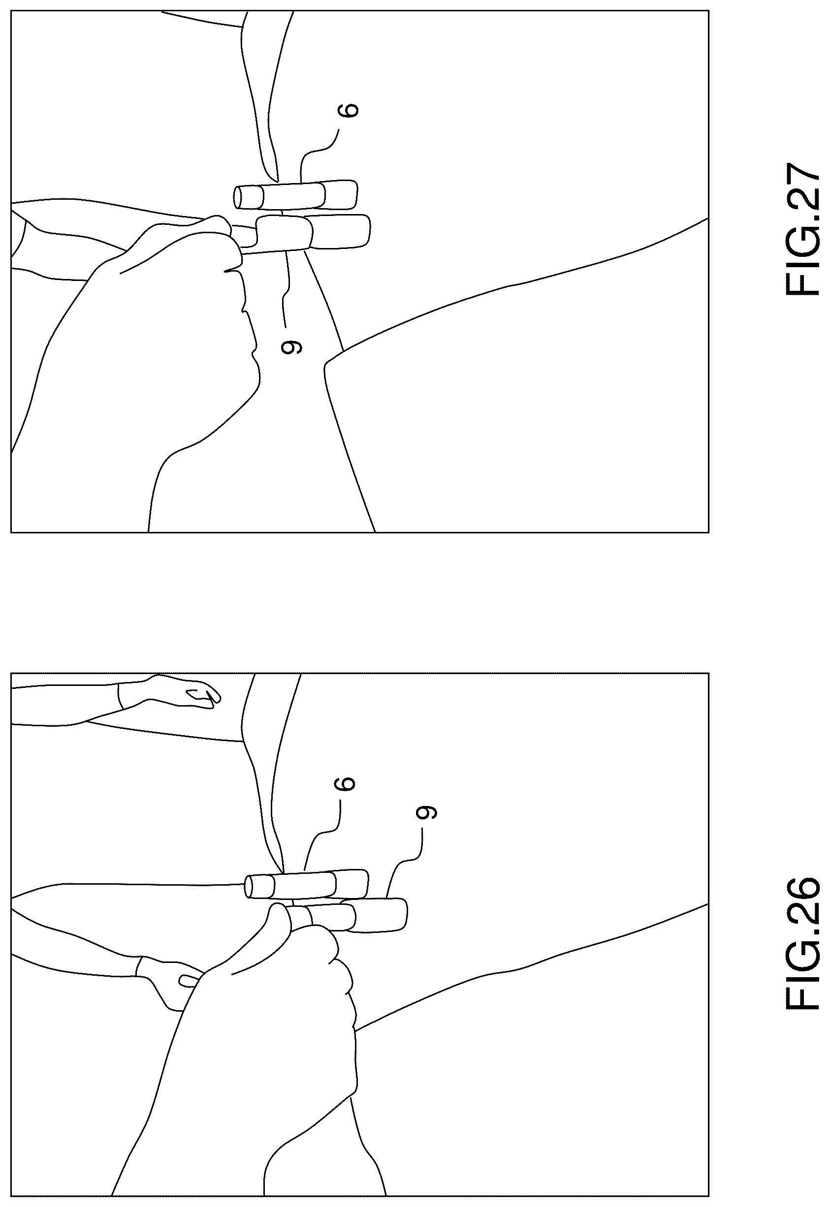 Patent US12396760 Figure 18 – Orthopedic implant kit