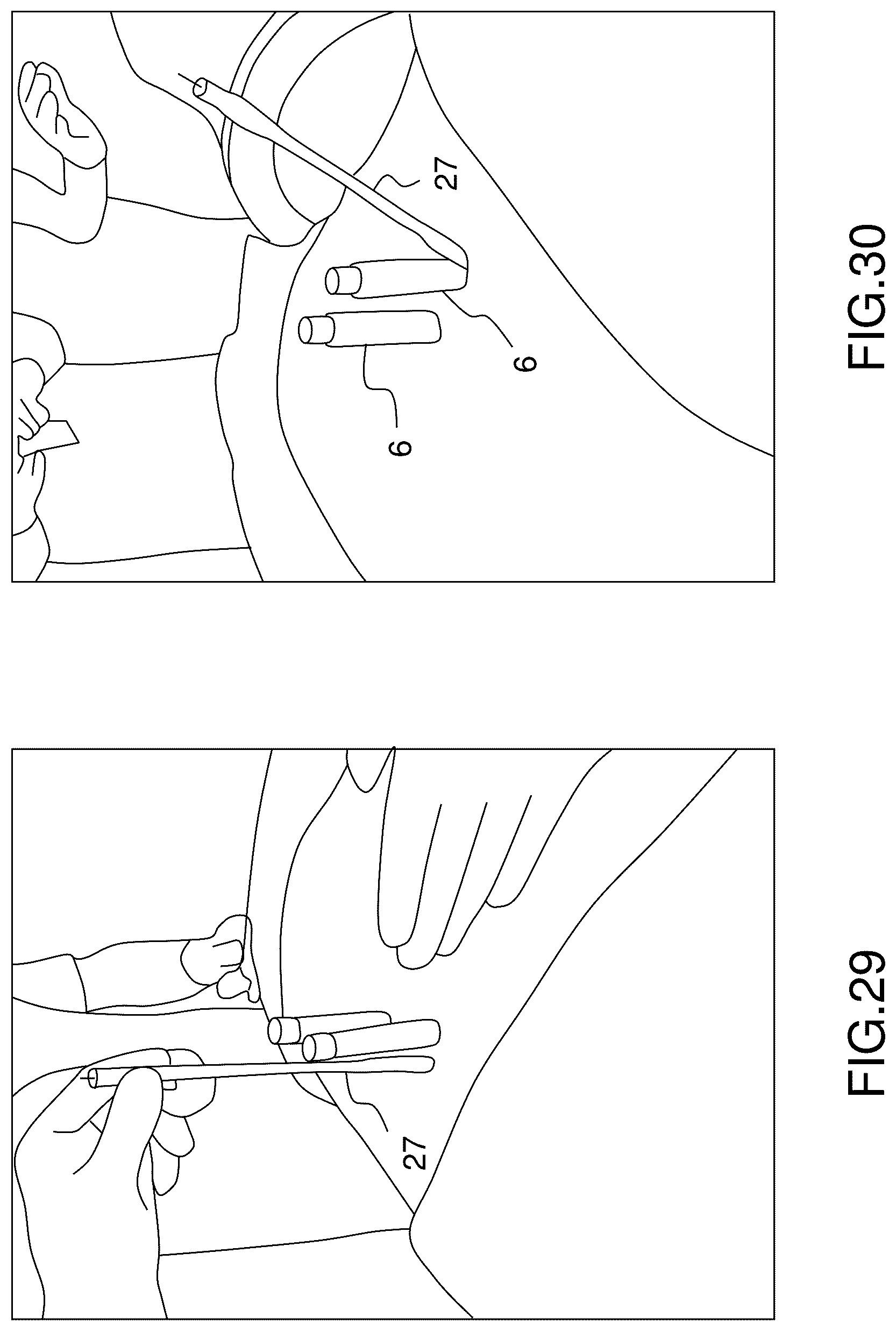 Patent US12396760 Figure 20 – Orthopedic implant kit