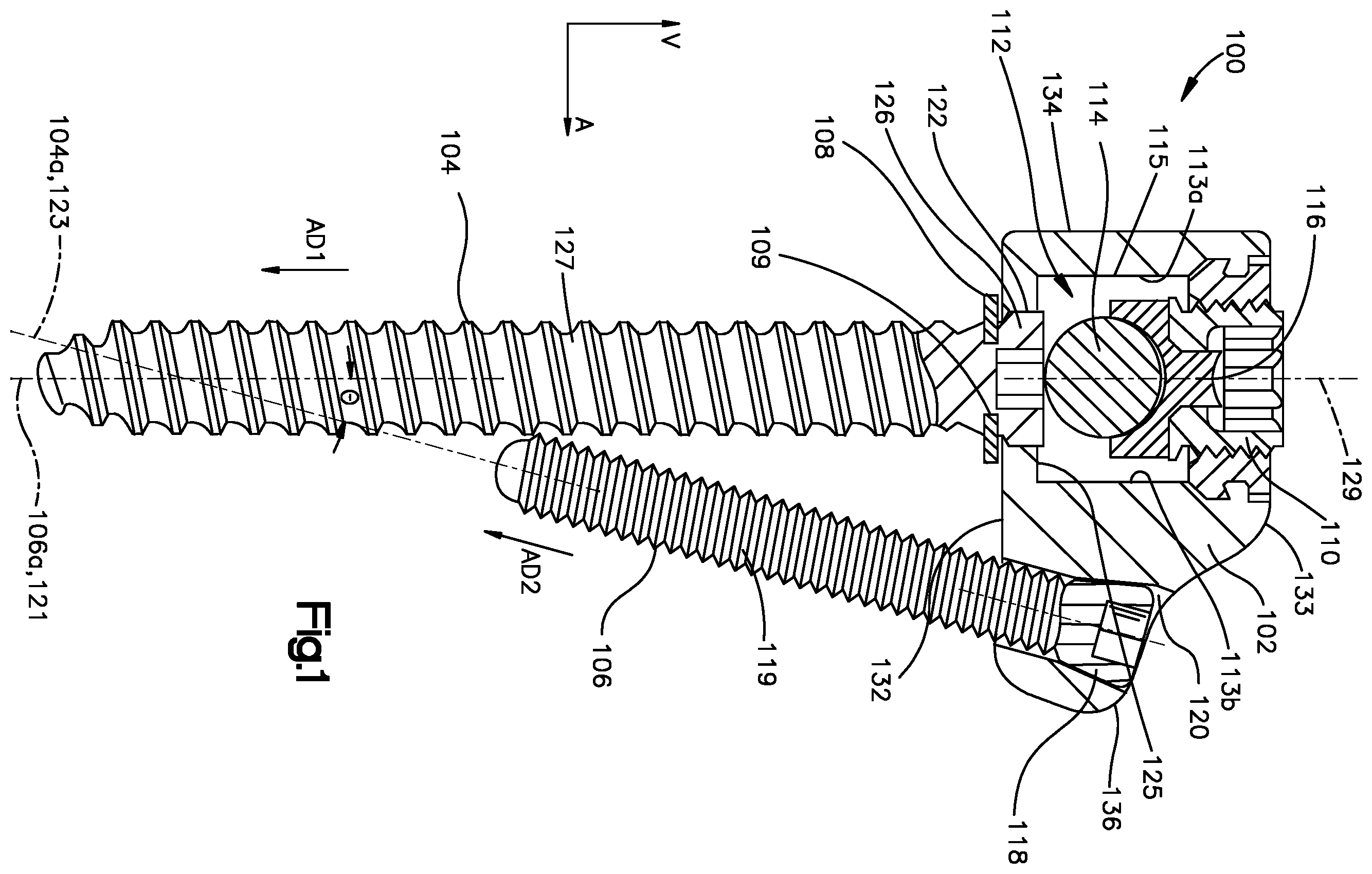Patent US12396761 — Device, kit and method for correction of spinal deformity — Figure 1