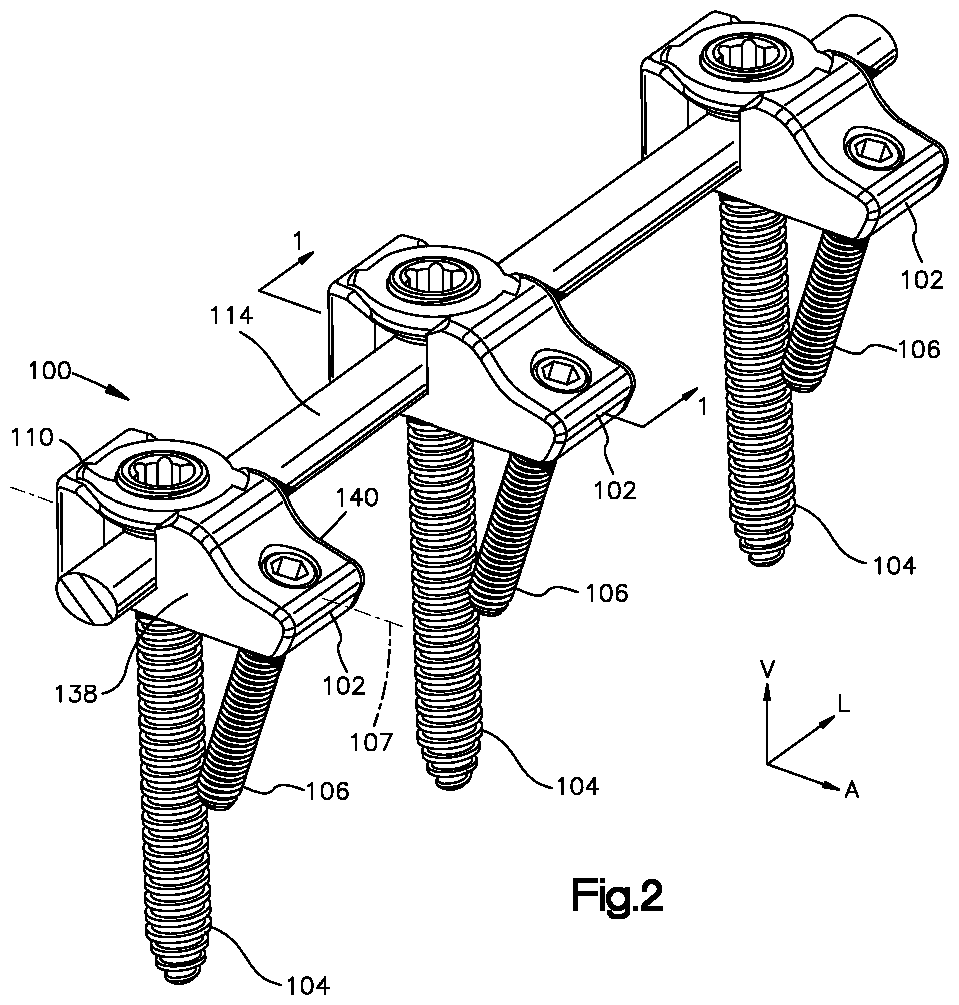 Patent US12396761 Figure 2 – Device, kit and method for correction of spinal deformity