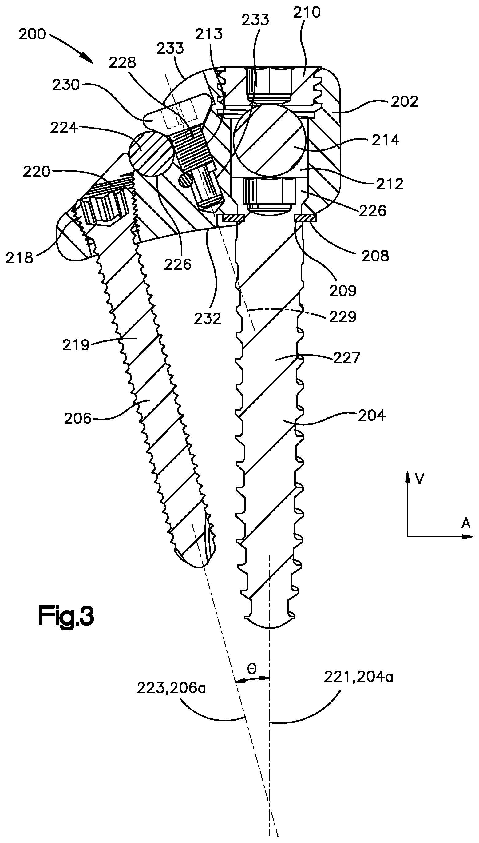 Patent US12396761 Figure 3 – Device, kit and method for correction of spinal deformity