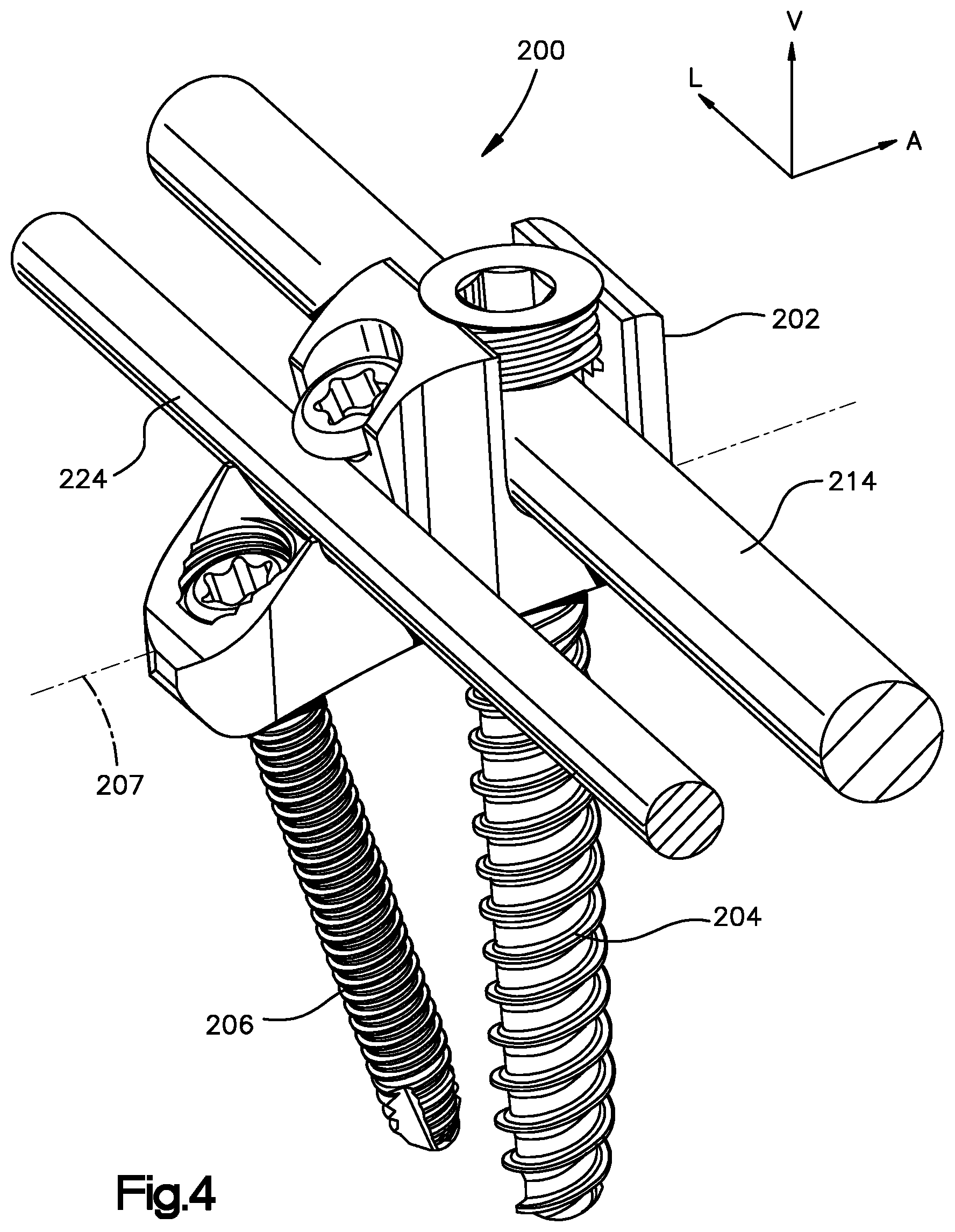 Patent US12396761 Figure 4 – Device, kit and method for correction of spinal deformity
