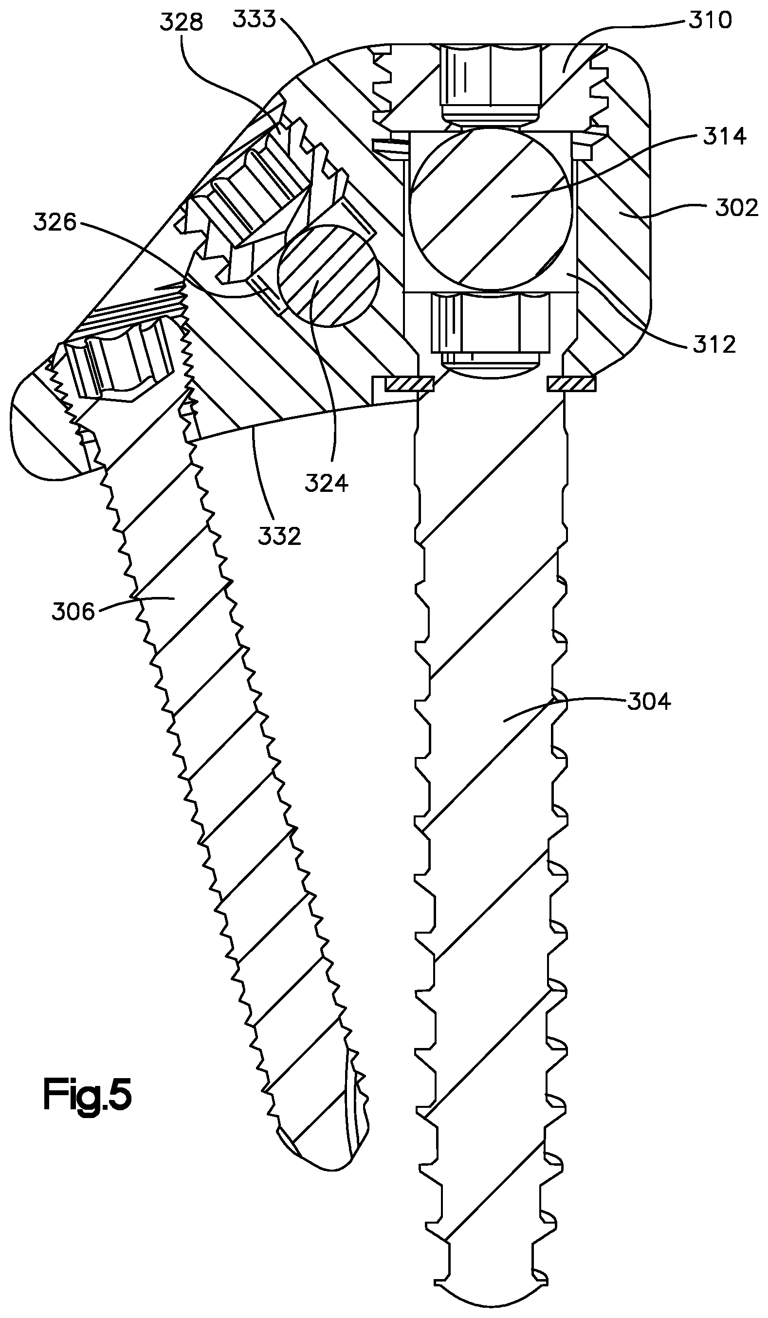 Patent US12396761 Figure 5 – Device, kit and method for correction of spinal deformity