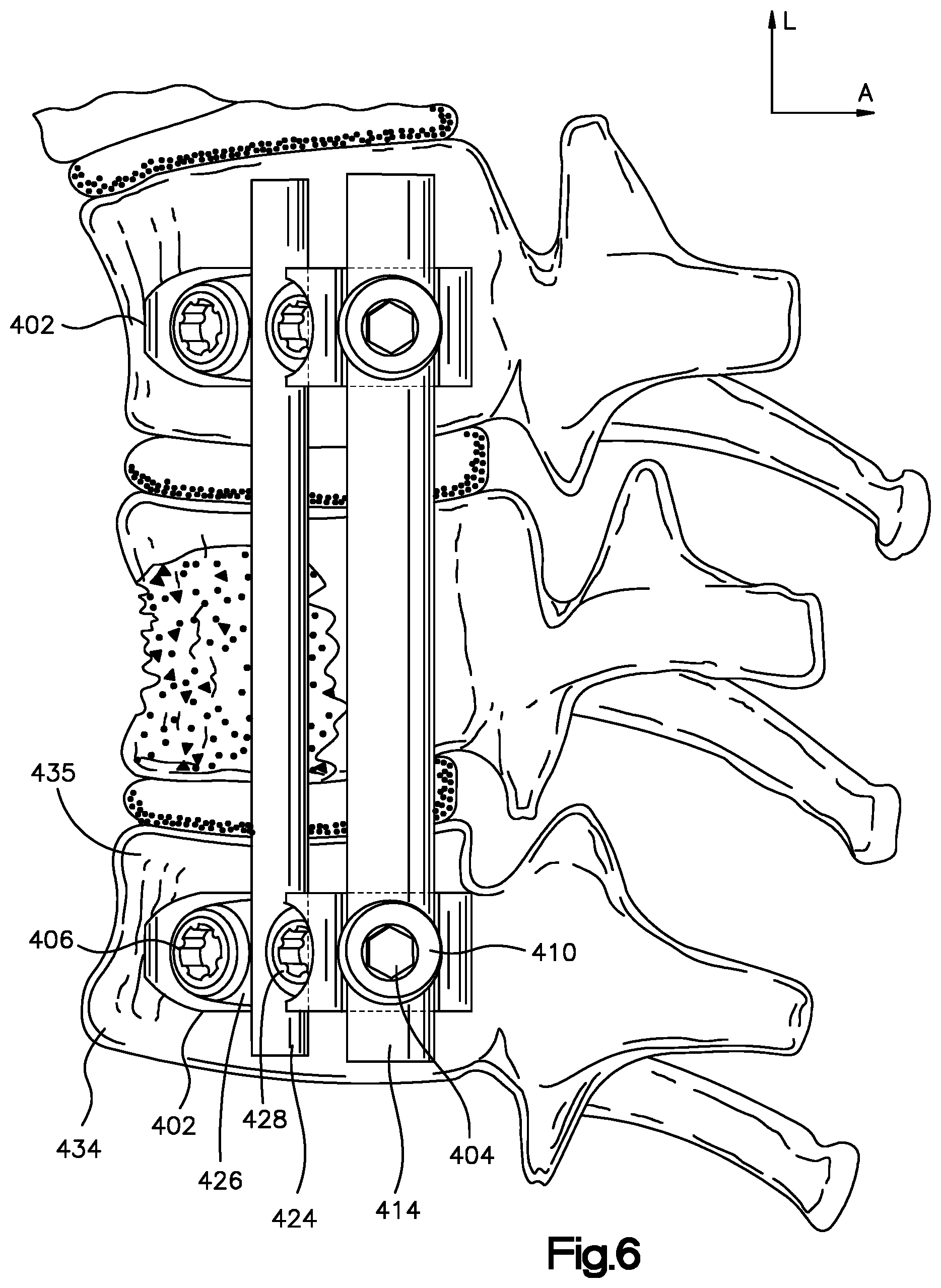 Patent US12396761 Figure 6 – Device, kit and method for correction of spinal deformity