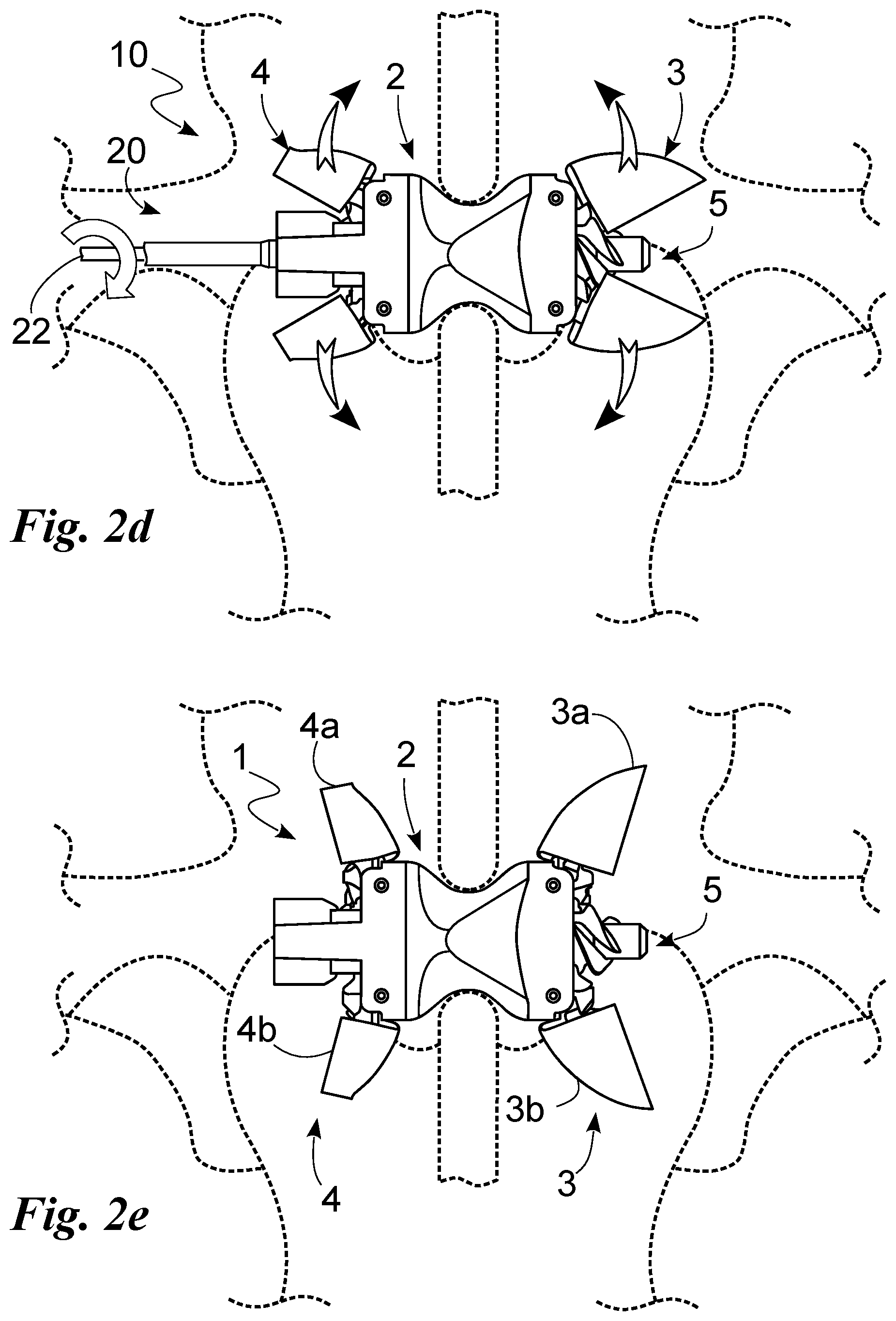 Patent US12396762 Figure 4 – Interspinous vertebral distractor