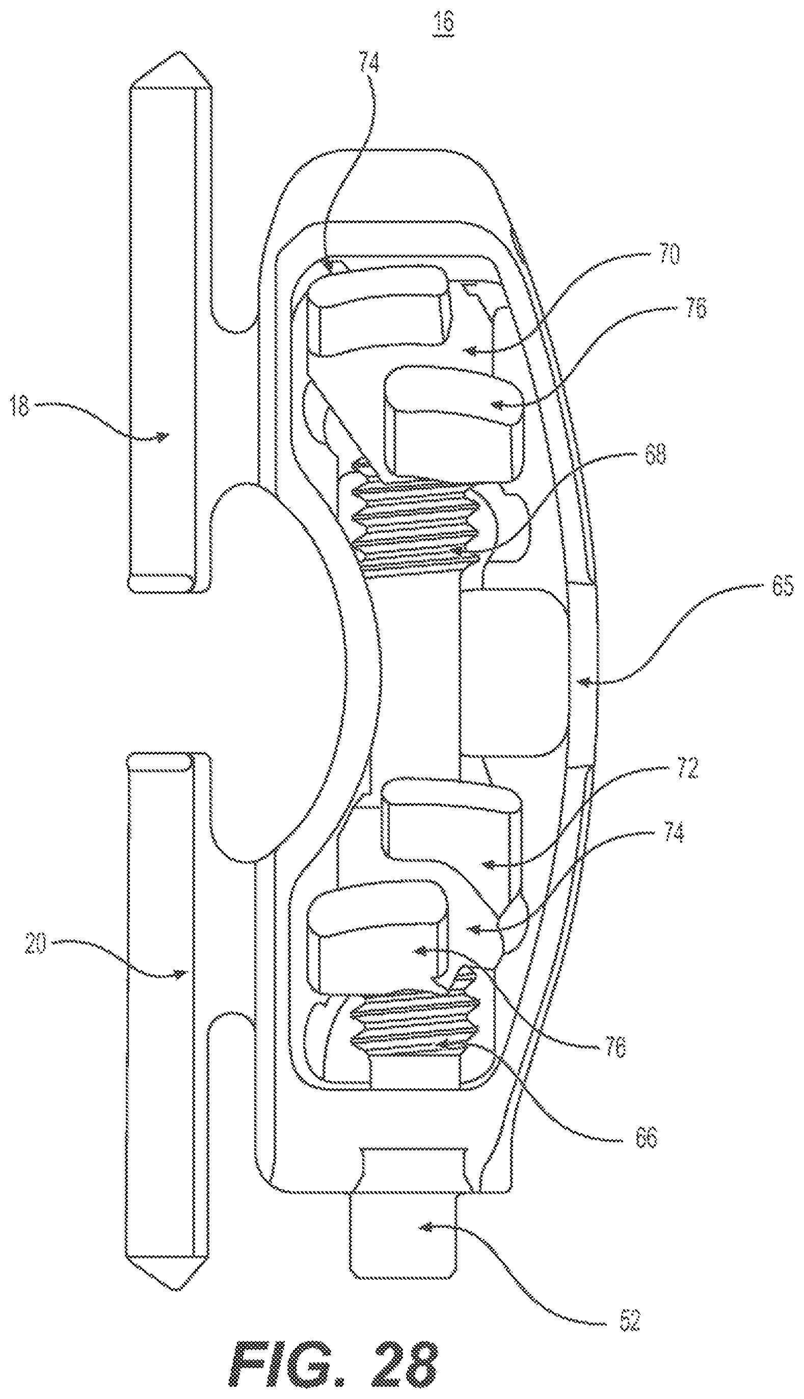 Patent US12396763 Figure 15 – Spinous process fixation system and methods thereof