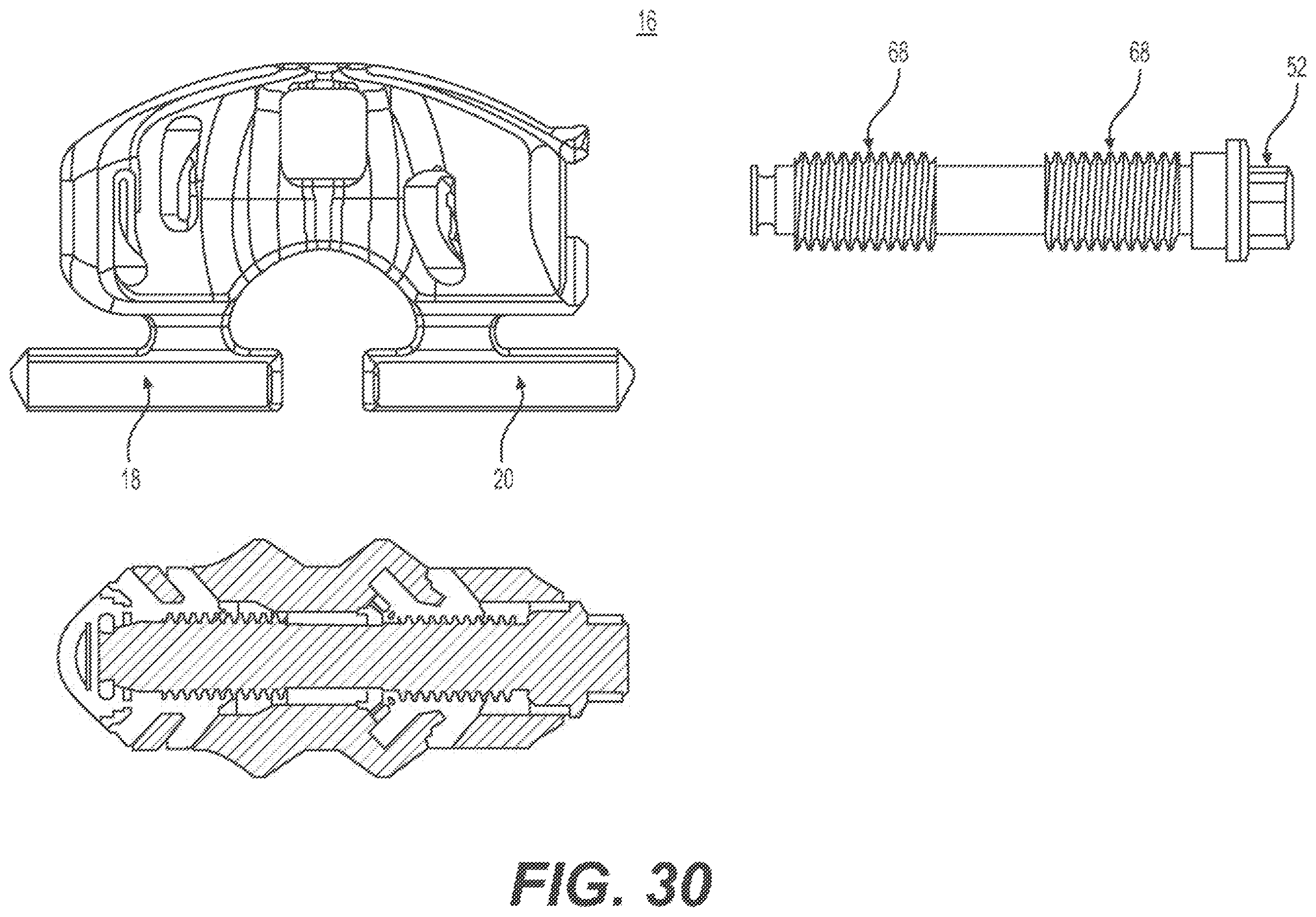 Patent US12396763 Figure 17 – Spinous process fixation system and methods thereof