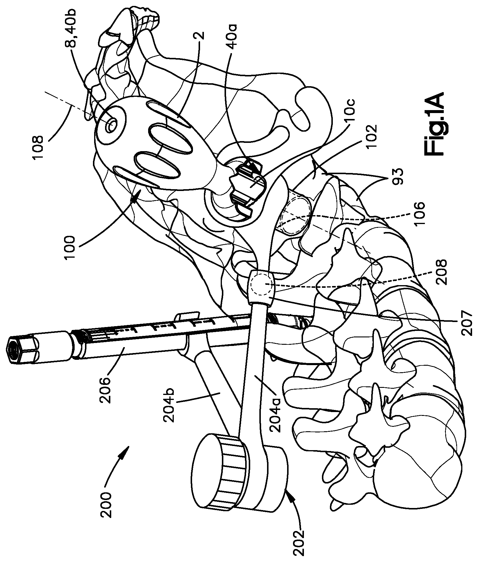 Patent US12396764 Figure 1 – Control member for adjusting access tube position, and related systems and methods