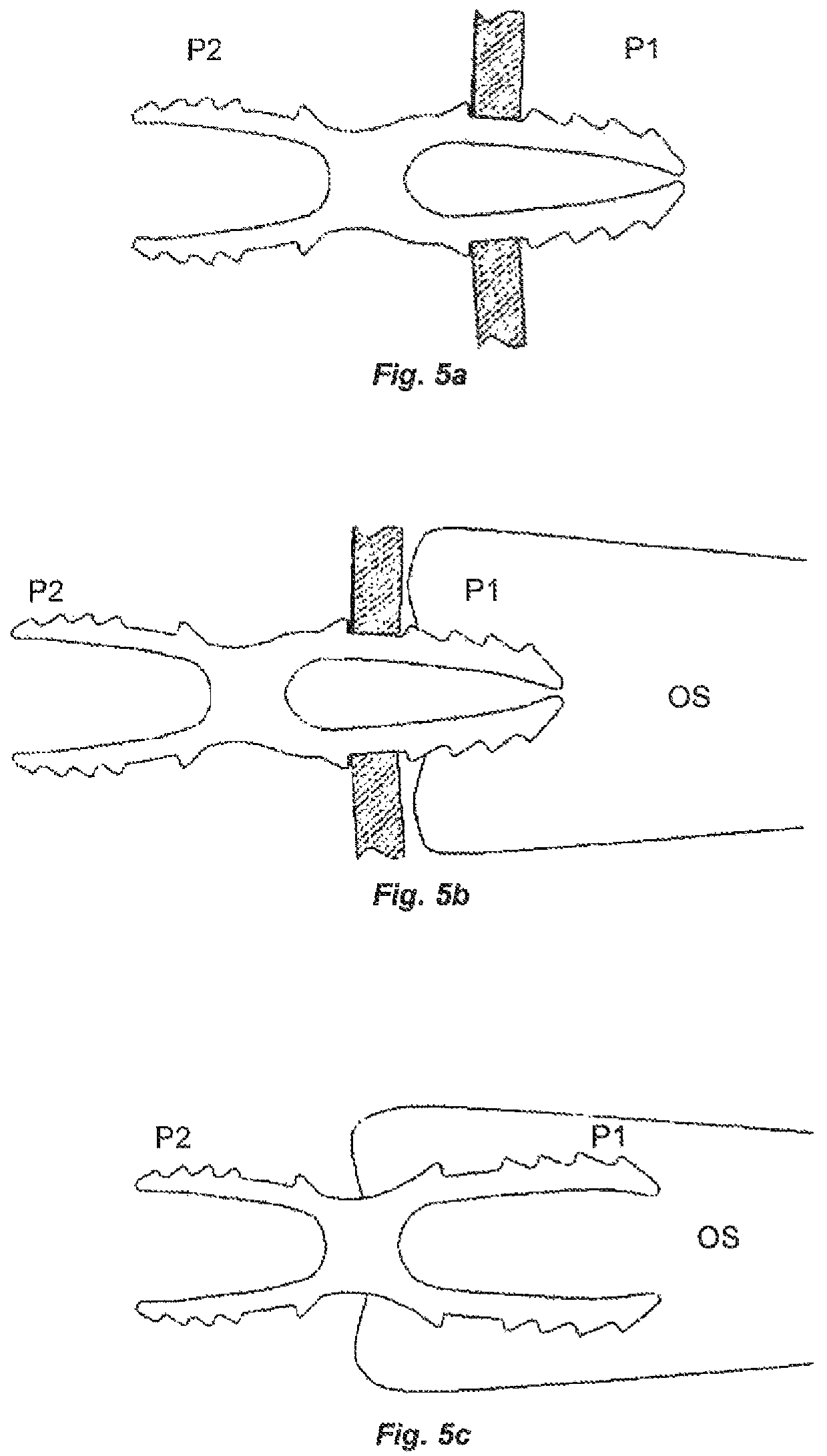 Patent US12396766 Figure 5 – Osteosynthesis device