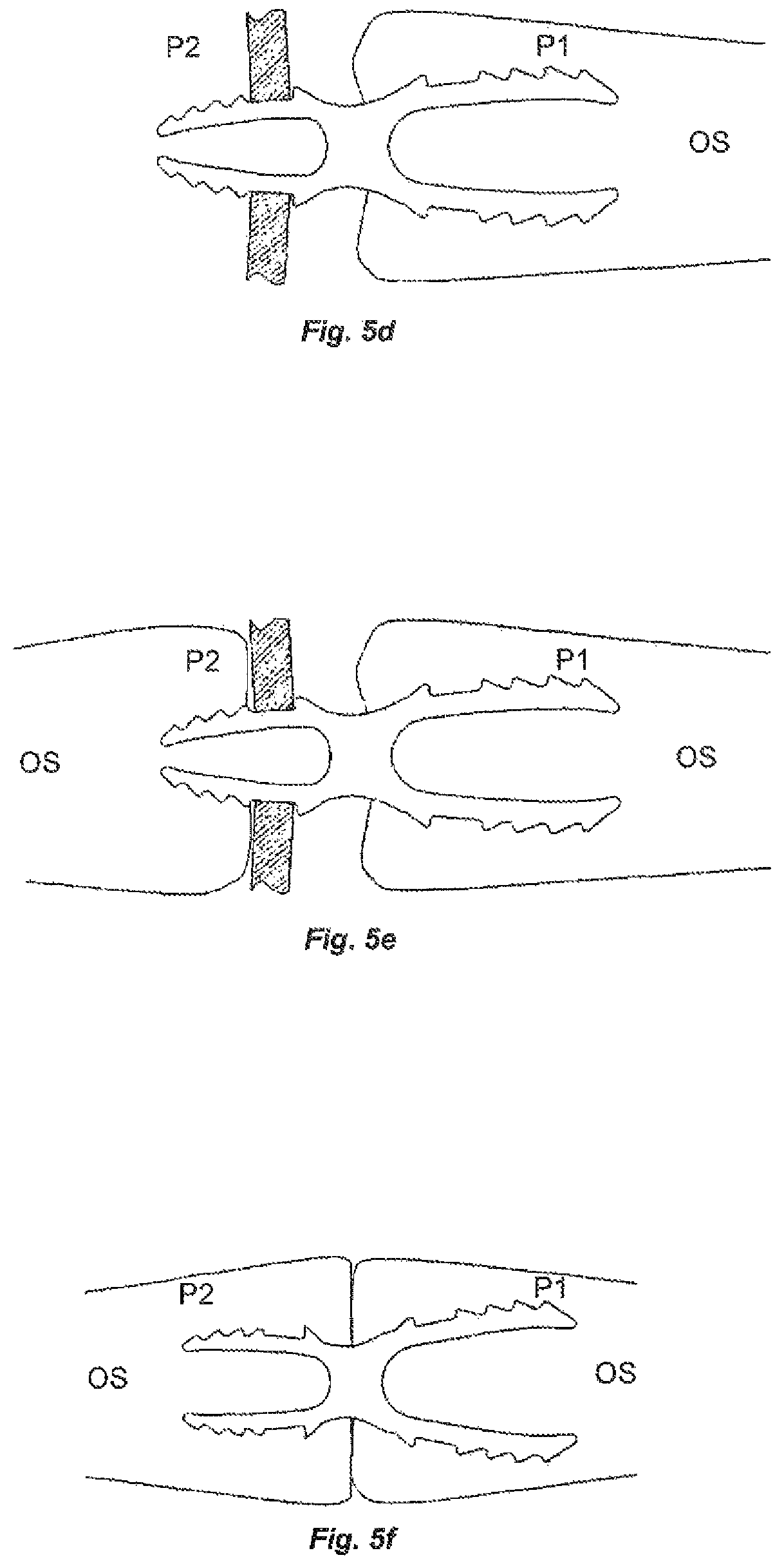 Patent US12396766 Figure 6 – Osteosynthesis device