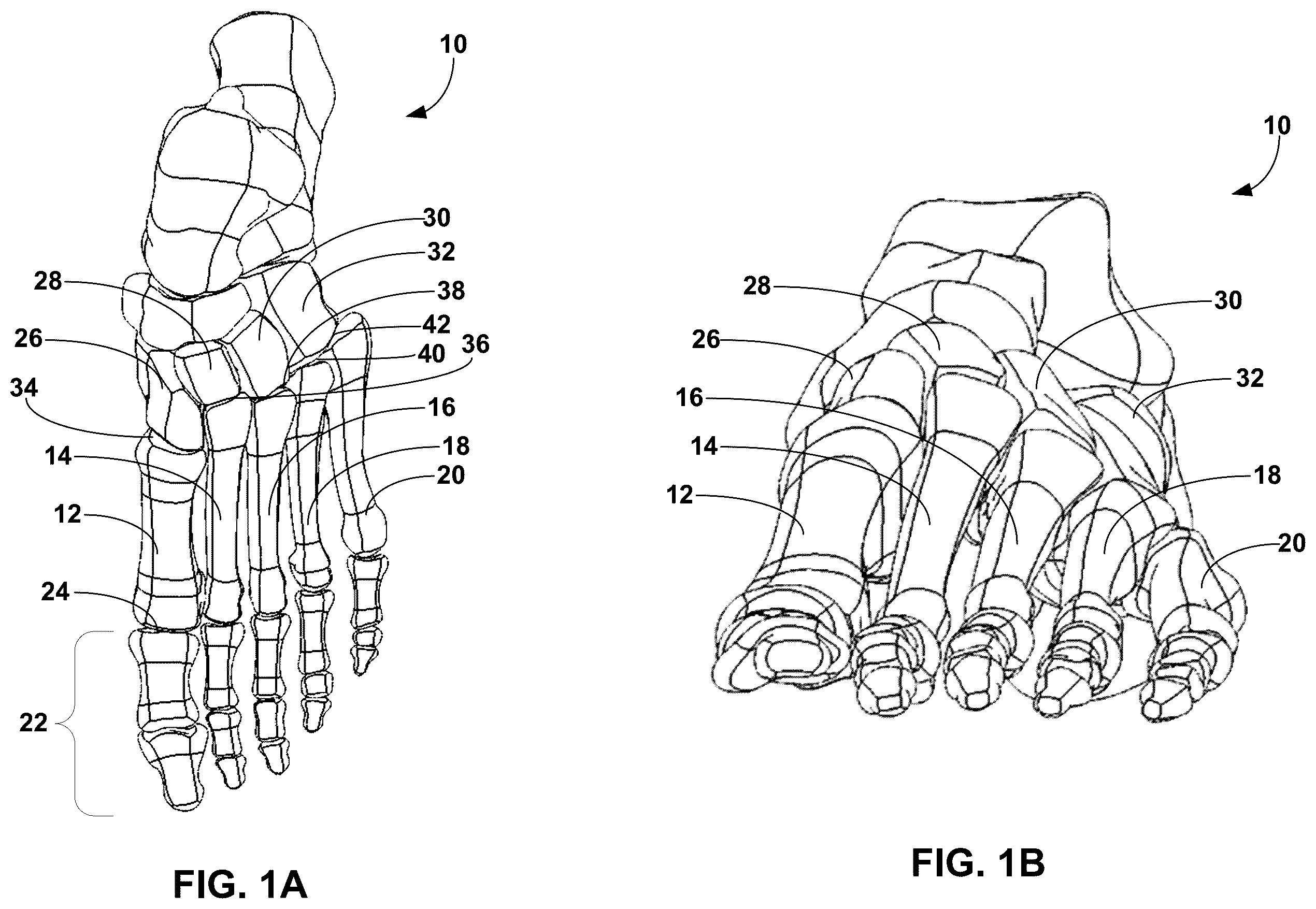 Patent US12396770 Figure 1 – Devices and techniques for treating metatarsus adductus