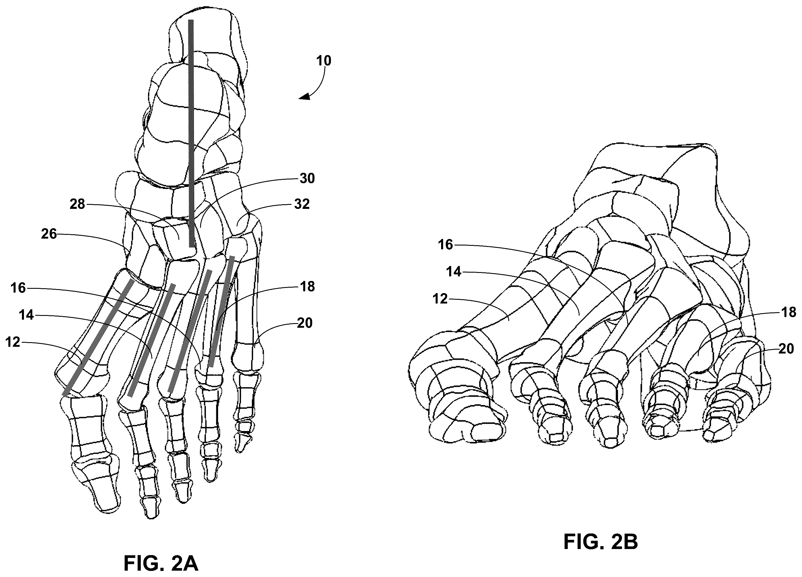 Patent US12396770 Figure 2 – Devices and techniques for treating metatarsus adductus