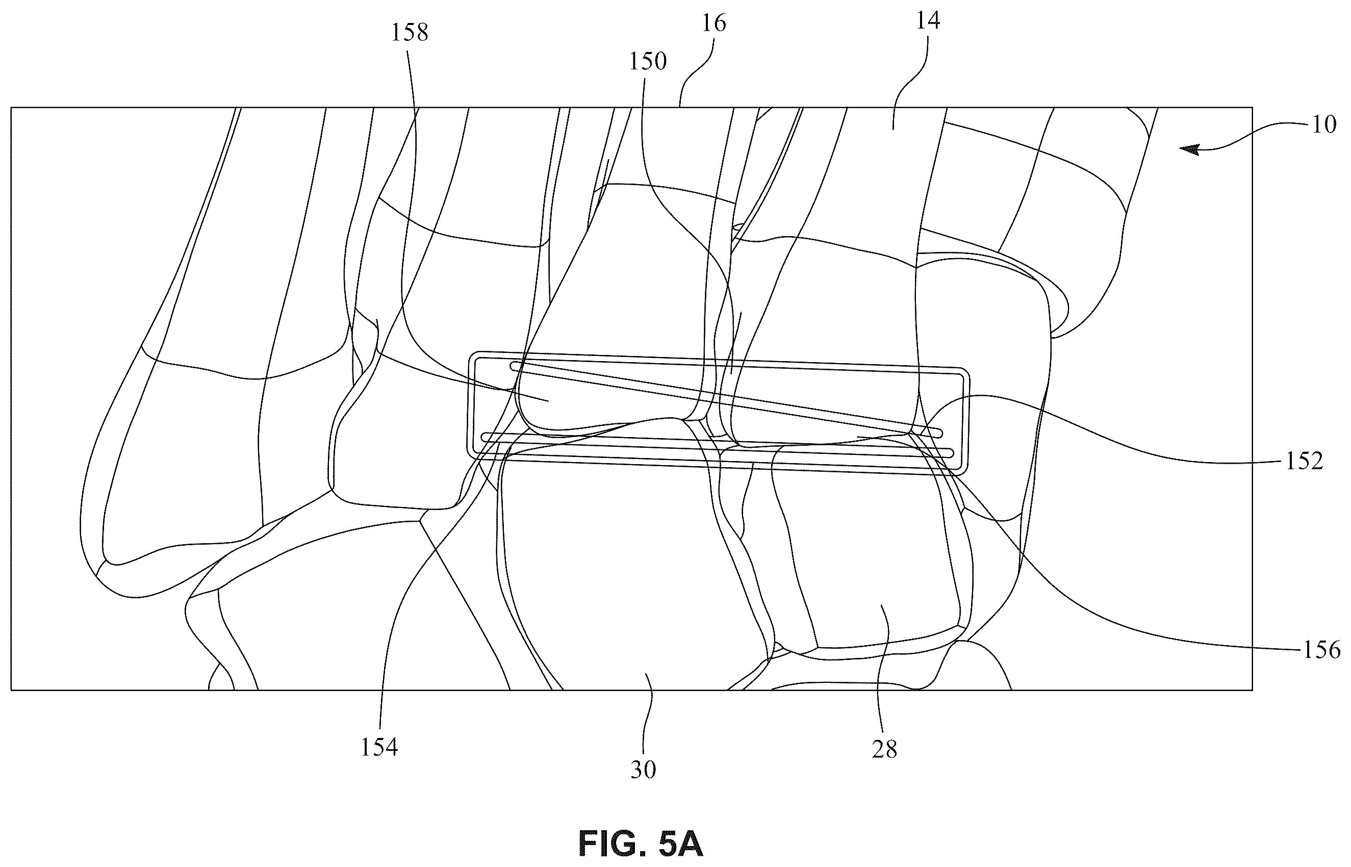 Patent US12396770 Figure 6 – Devices and techniques for treating metatarsus adductus
