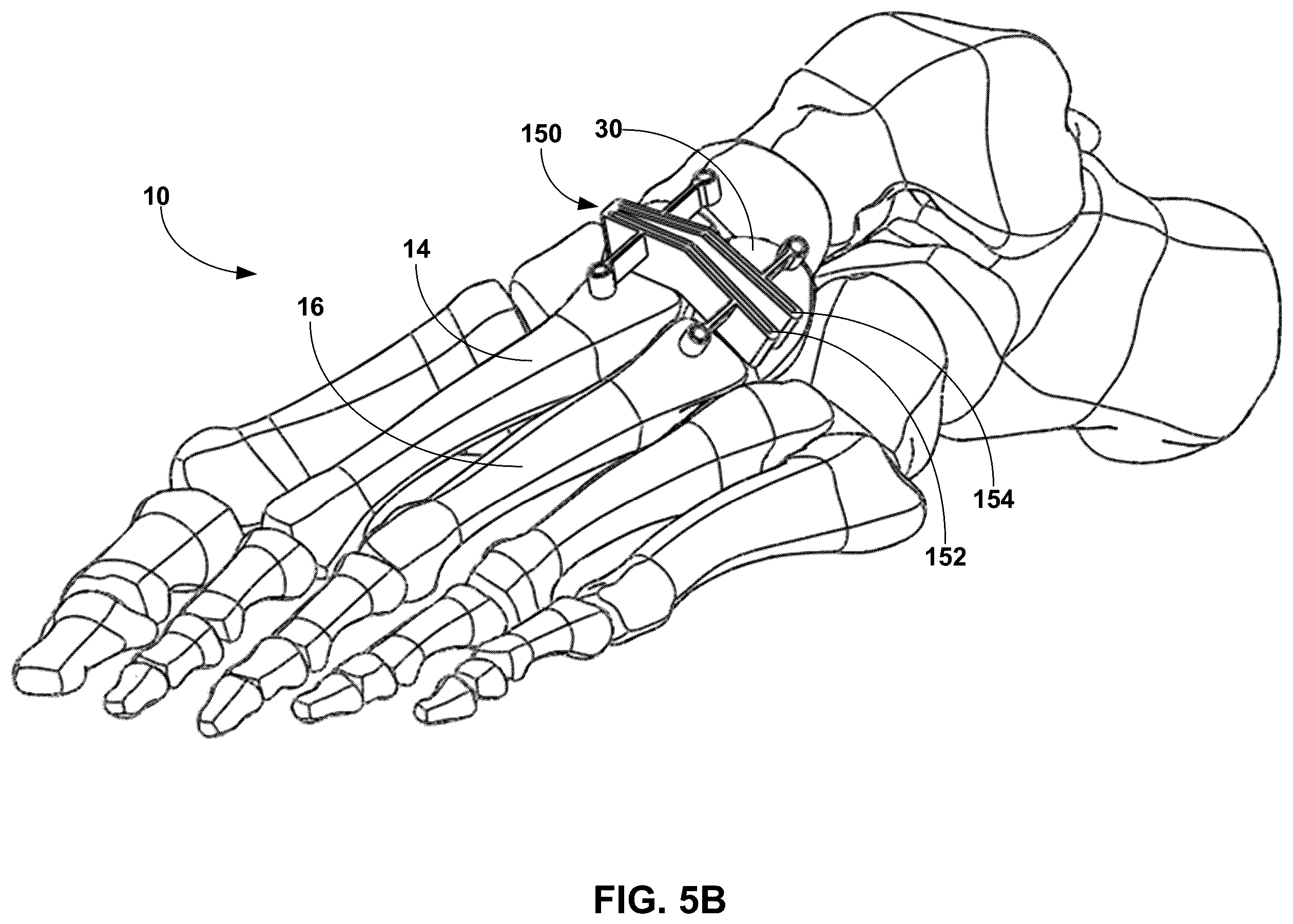 Patent US12396770 Figure 7 – Devices and techniques for treating metatarsus adductus