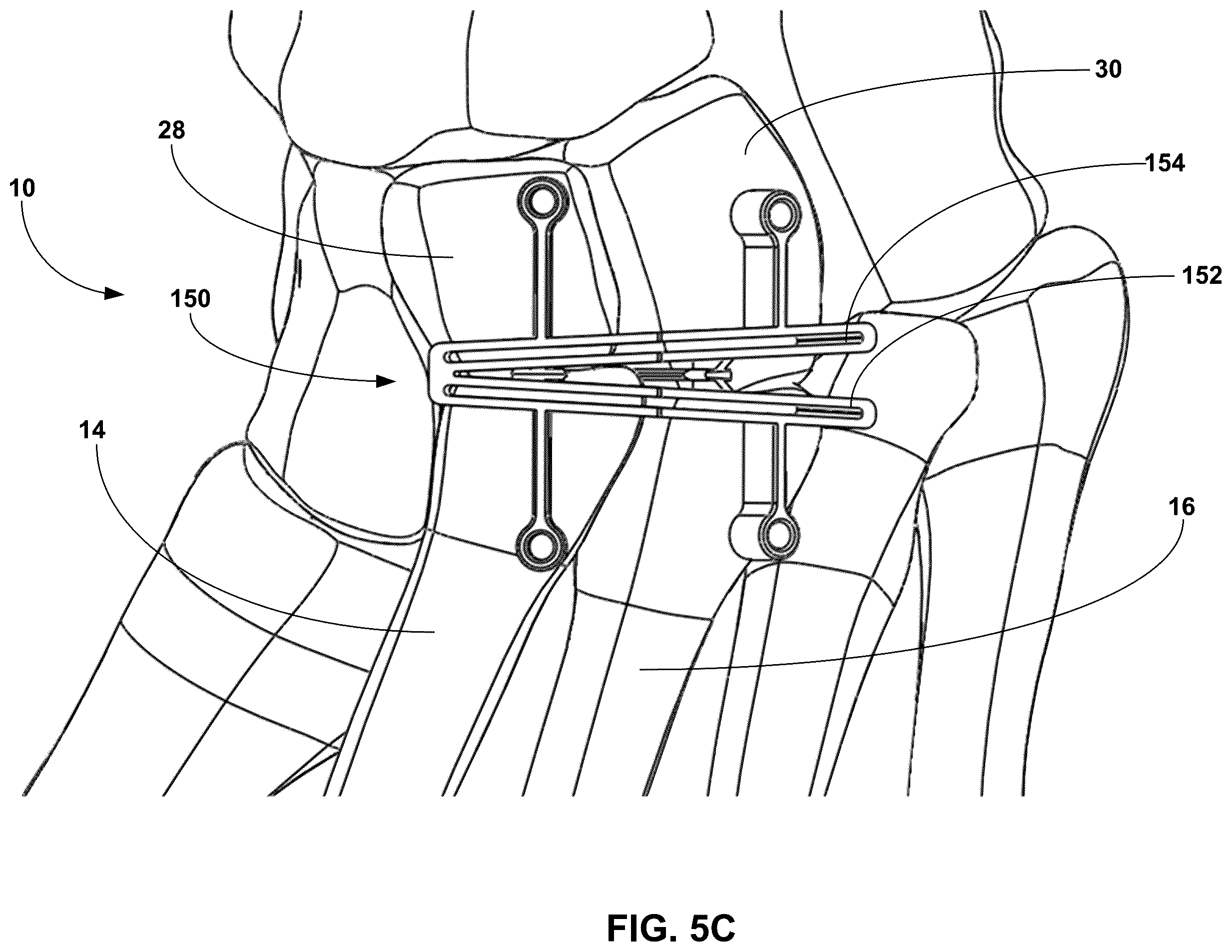 Patent US12396770 Figure 8 – Devices and techniques for treating metatarsus adductus