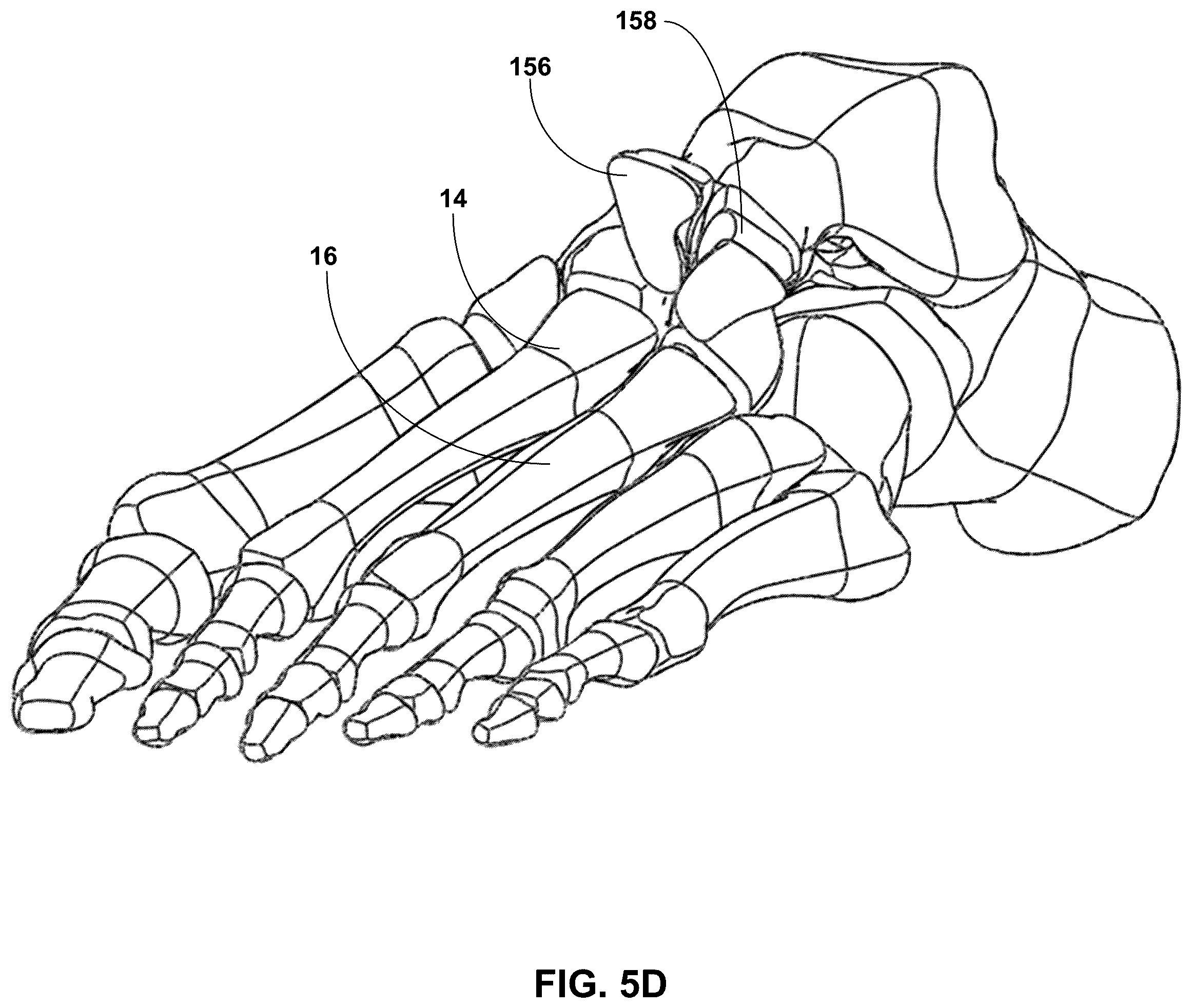 Patent US12396770 Figure 9 – Devices and techniques for treating metatarsus adductus