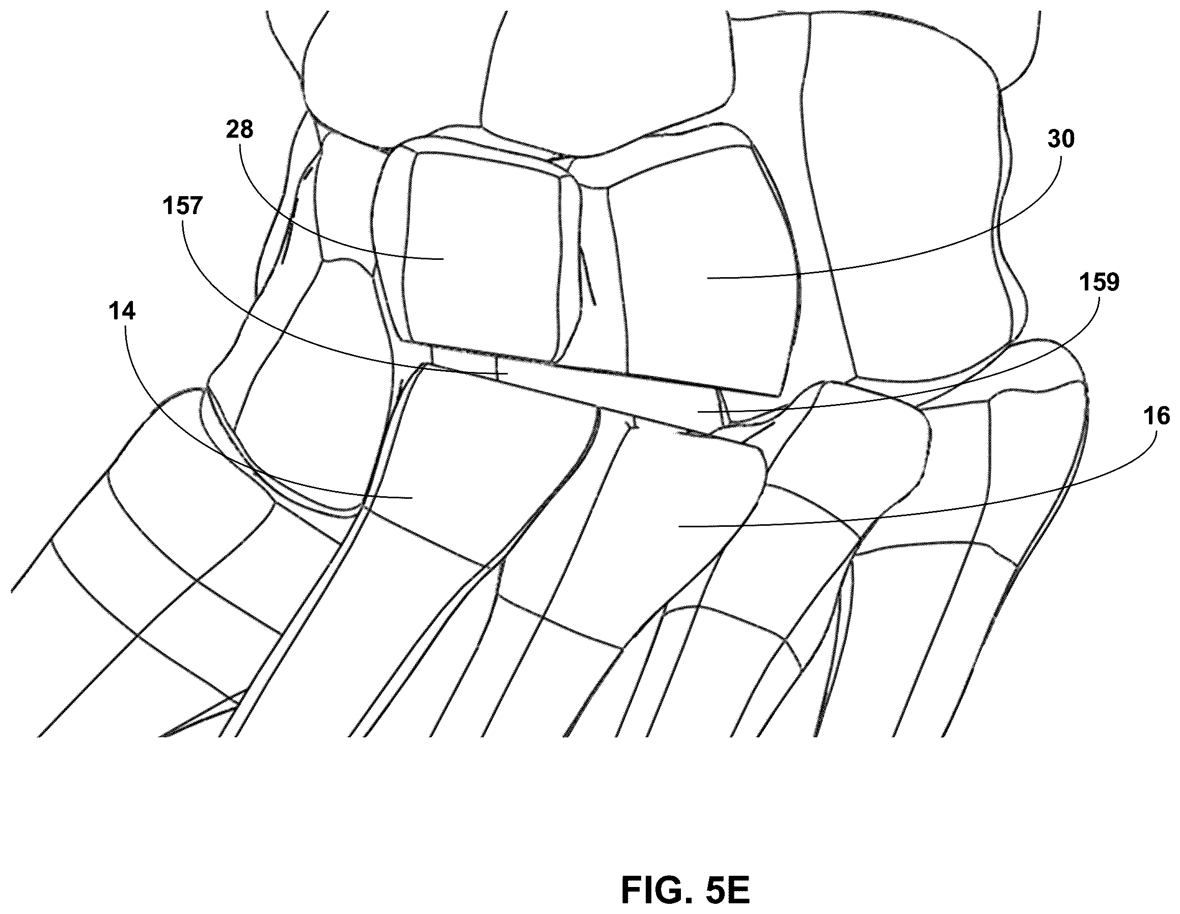 Patent US12396770 Figure 10 – Devices and techniques for treating metatarsus adductus