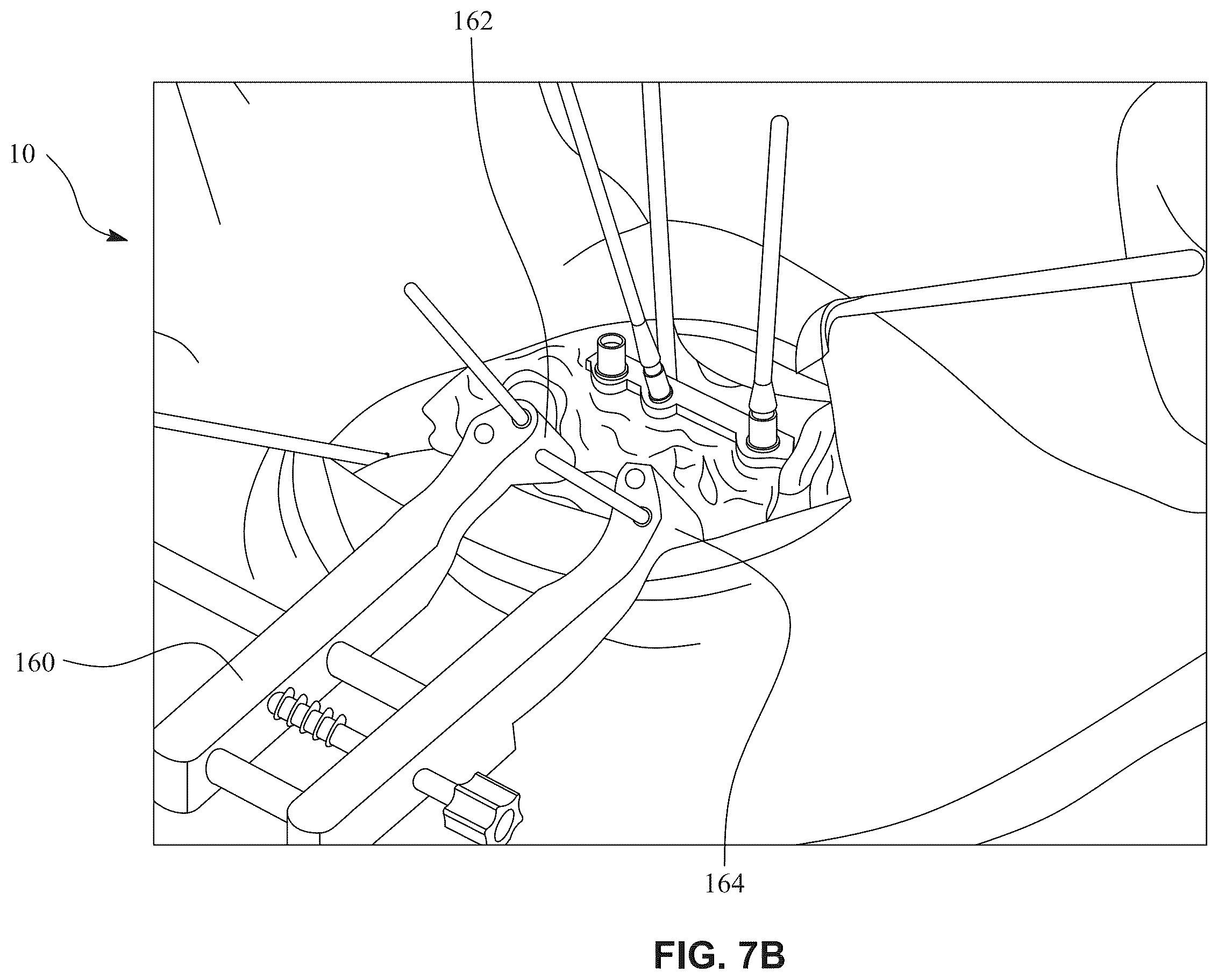Patent US12396770 Figure 13 – Devices and techniques for treating metatarsus adductus