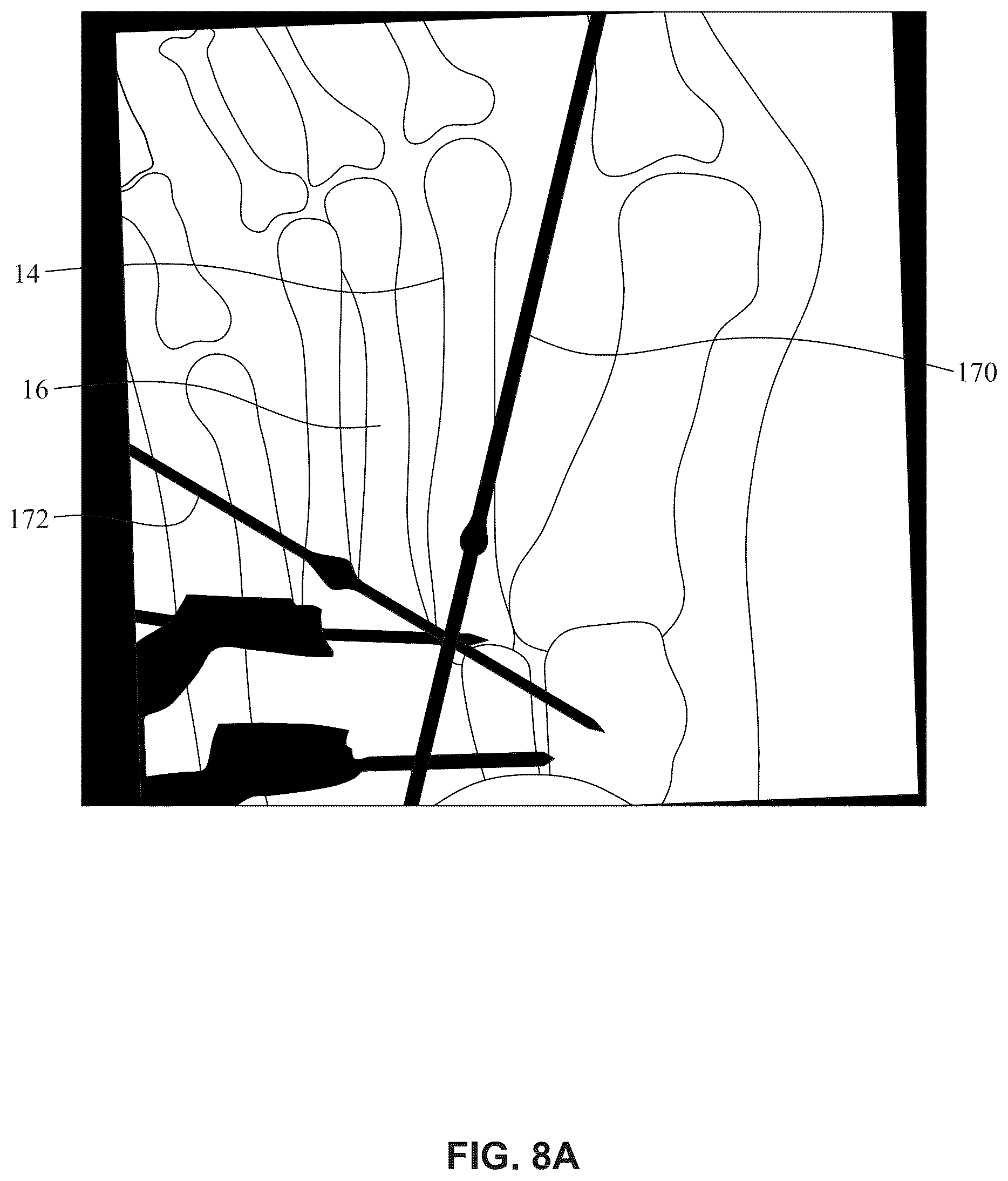 Patent US12396770 Figure 14 – Devices and techniques for treating metatarsus adductus