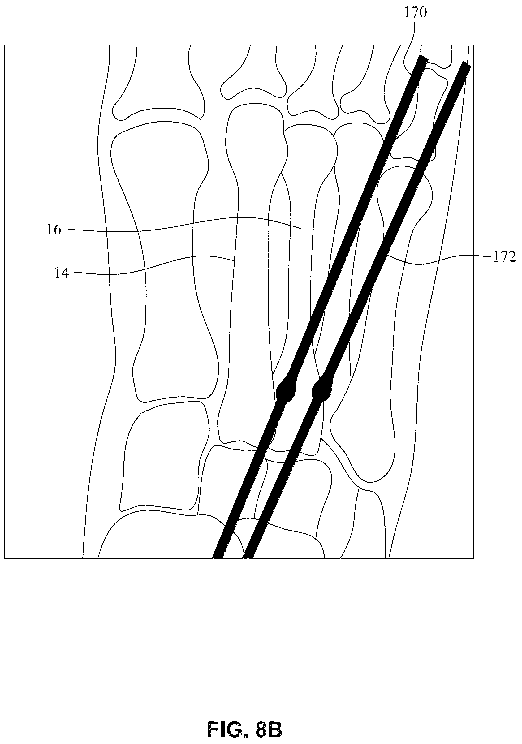 Patent US12396770 Figure 15 – Devices and techniques for treating metatarsus adductus