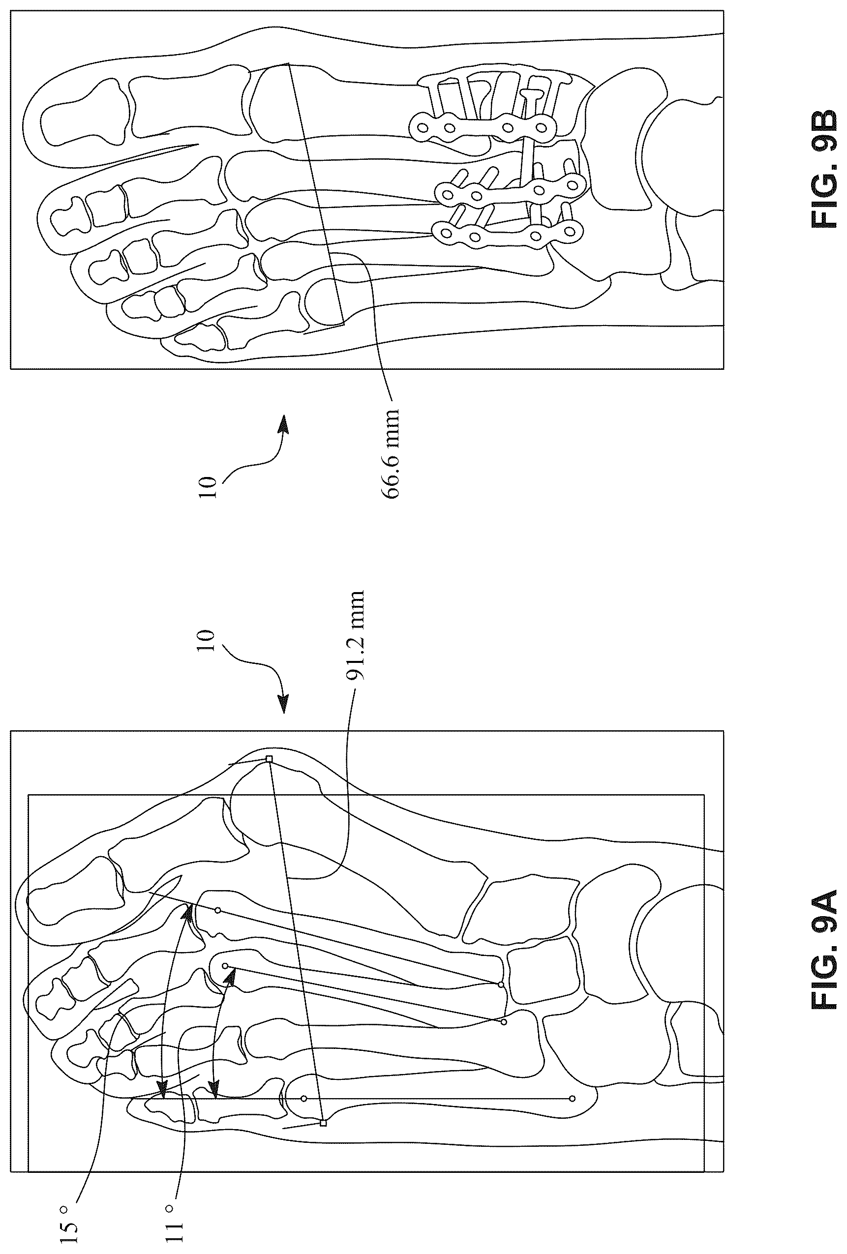 Patent US12396770 Figure 16 – Devices and techniques for treating metatarsus adductus