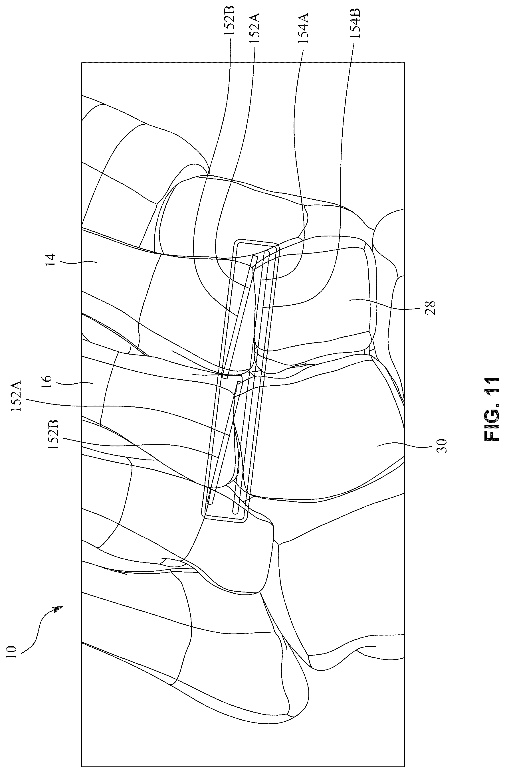 Patent US12396770 Figure 18 – Devices and techniques for treating metatarsus adductus