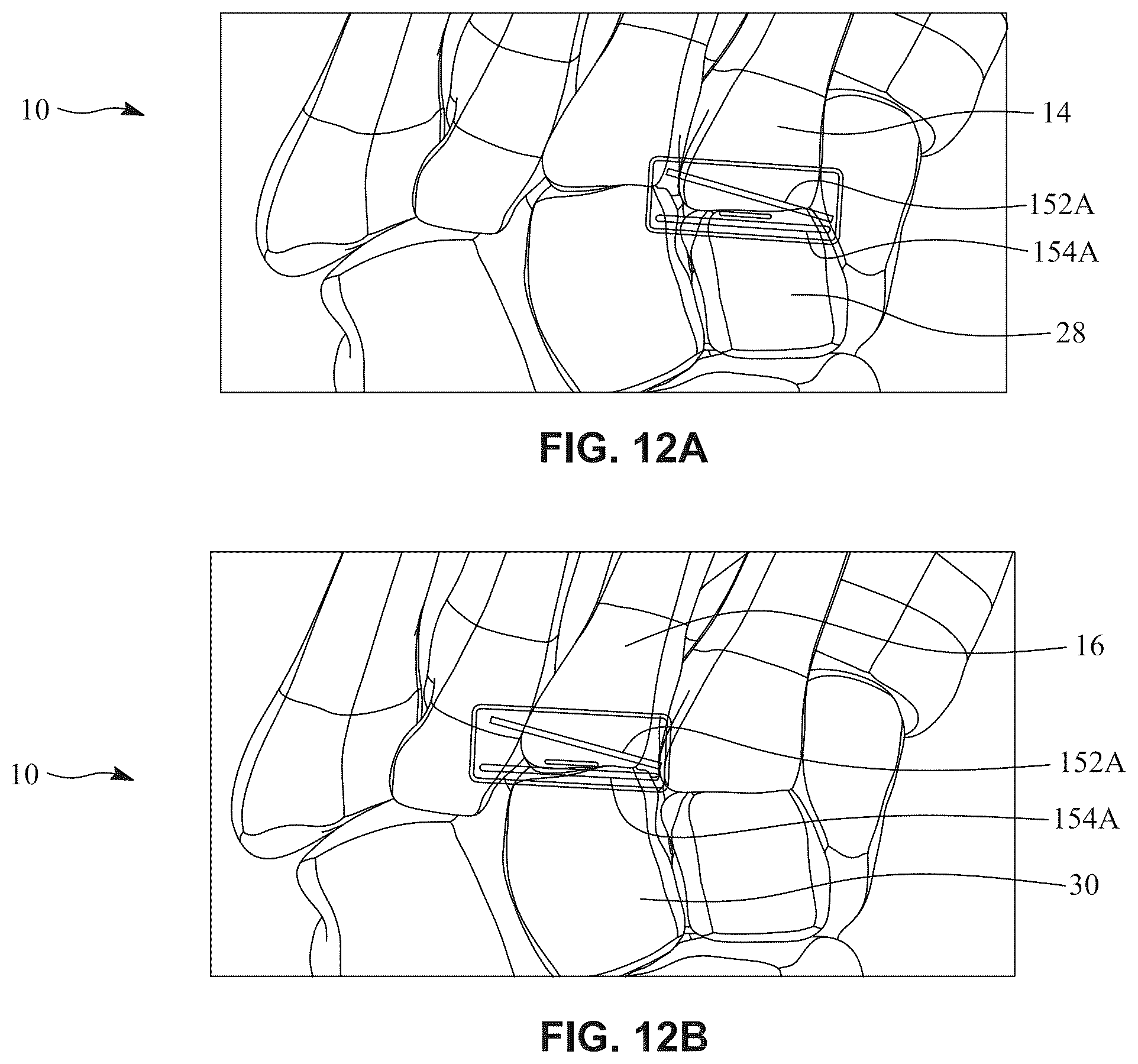 Patent US12396770 Figure 19 – Devices and techniques for treating metatarsus adductus