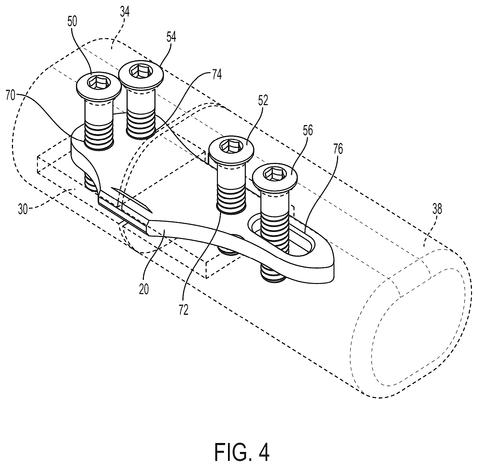 Patent US12396771 Figure 4 – Intra-osseous plate system and method