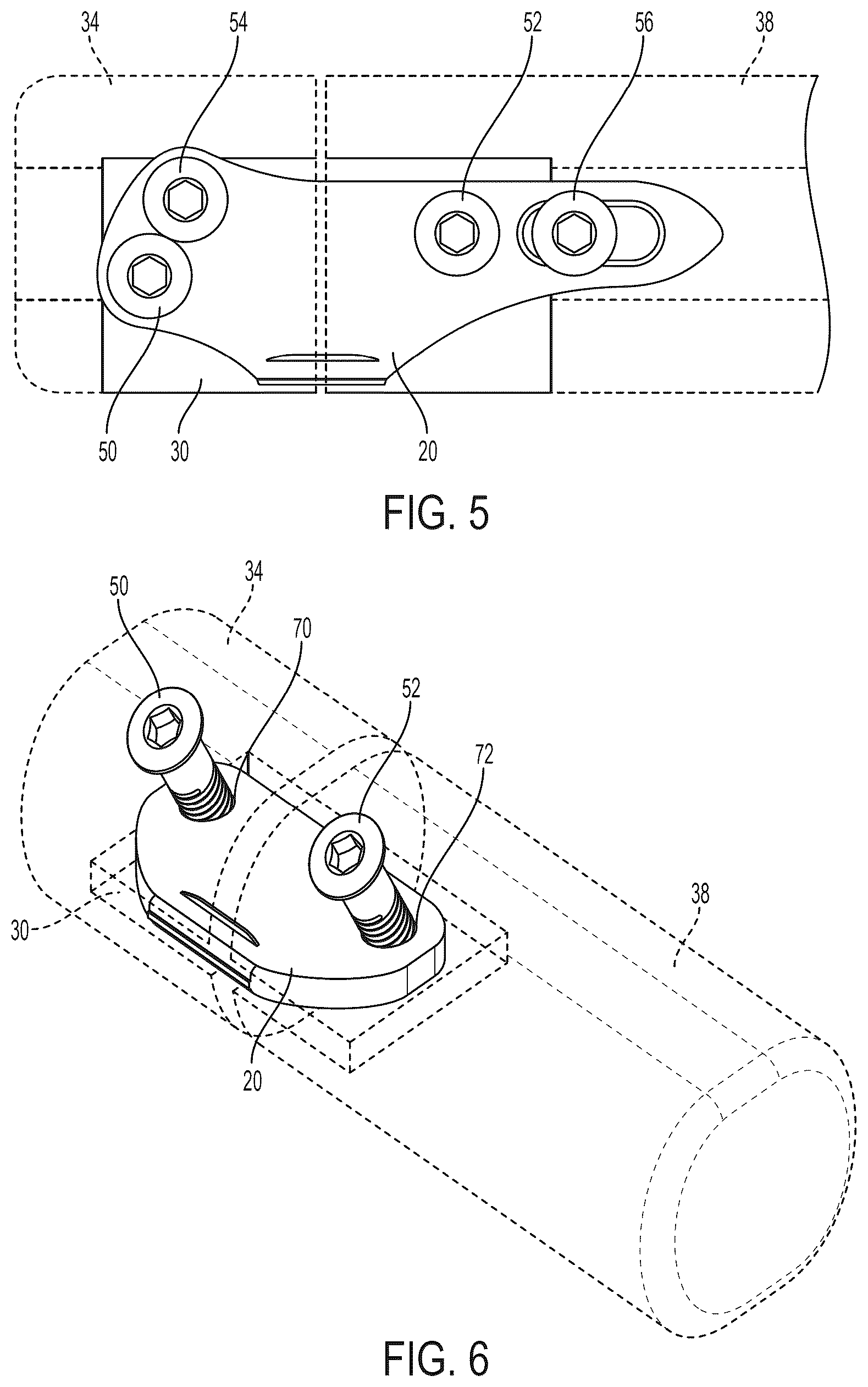 Patent US12396771 Figure 5 – Intra-osseous plate system and method
