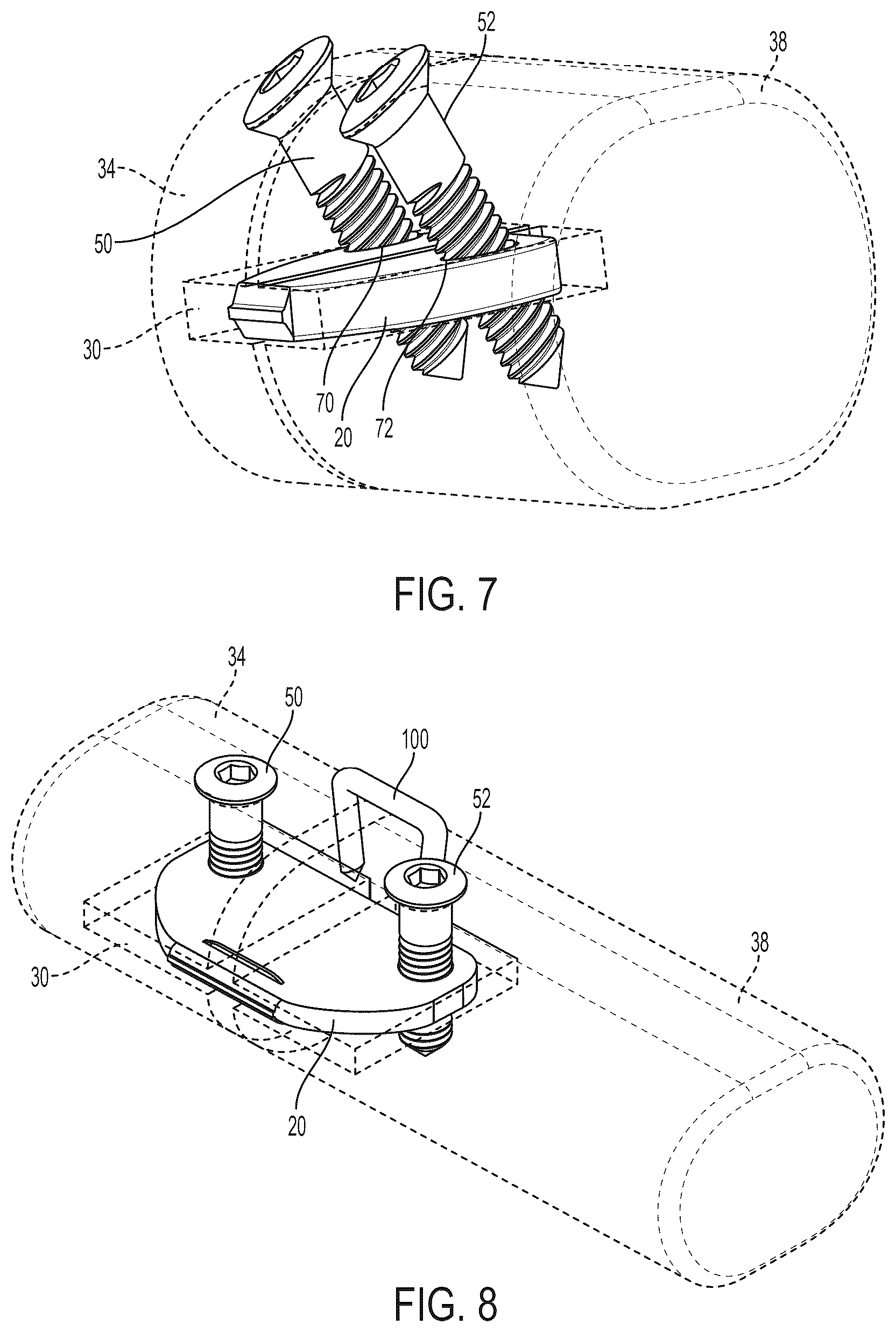 Patent US12396771 Figure 6 – Intra-osseous plate system and method