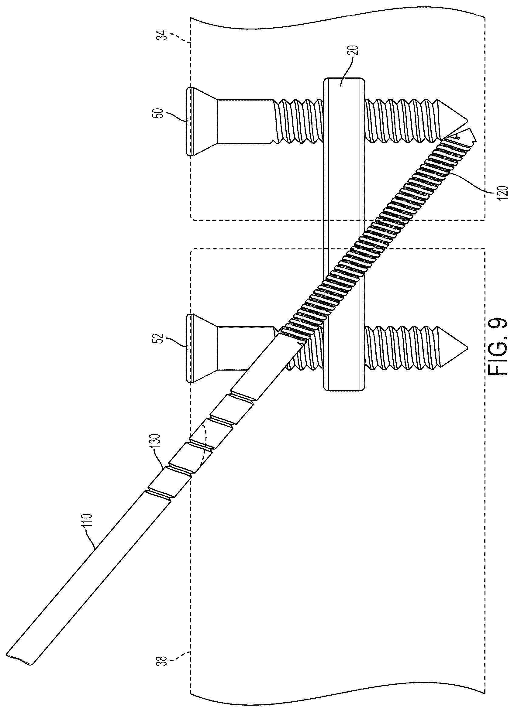 Patent US12396771 Figure 7 – Intra-osseous plate system and method