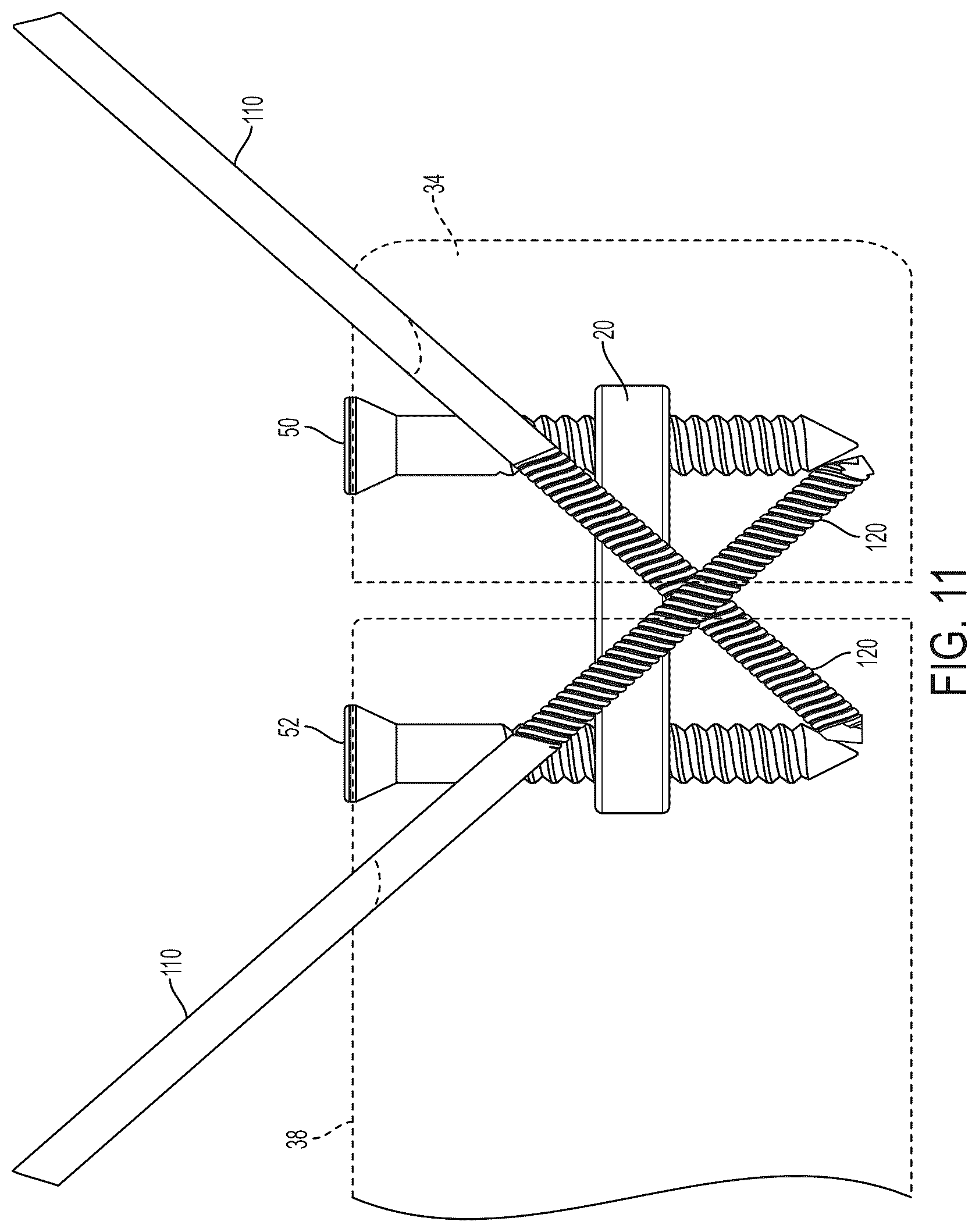 Patent US12396771 Figure 9 – Intra-osseous plate system and method