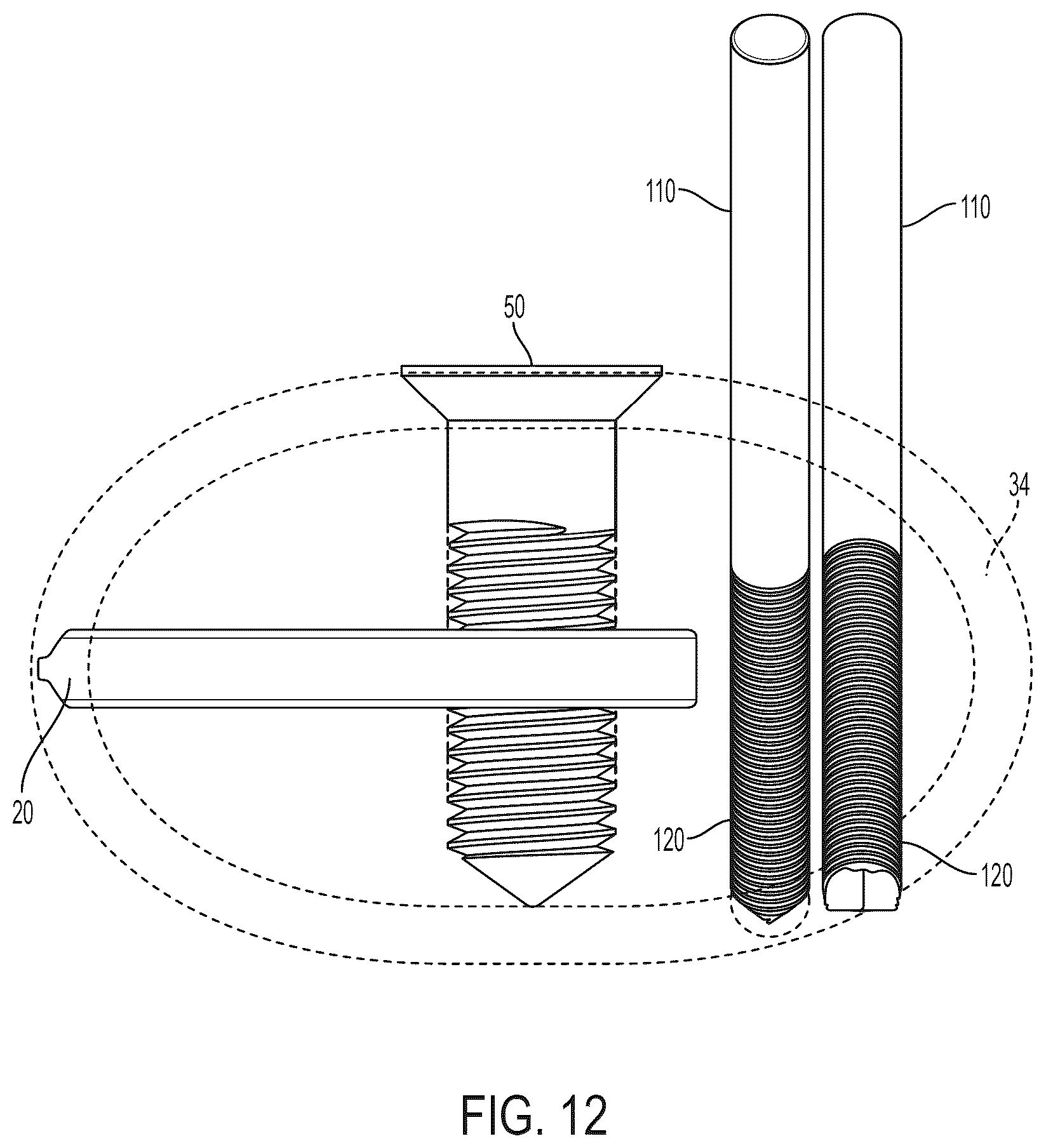 Patent US12396771 Figure 10 – Intra-osseous plate system and method