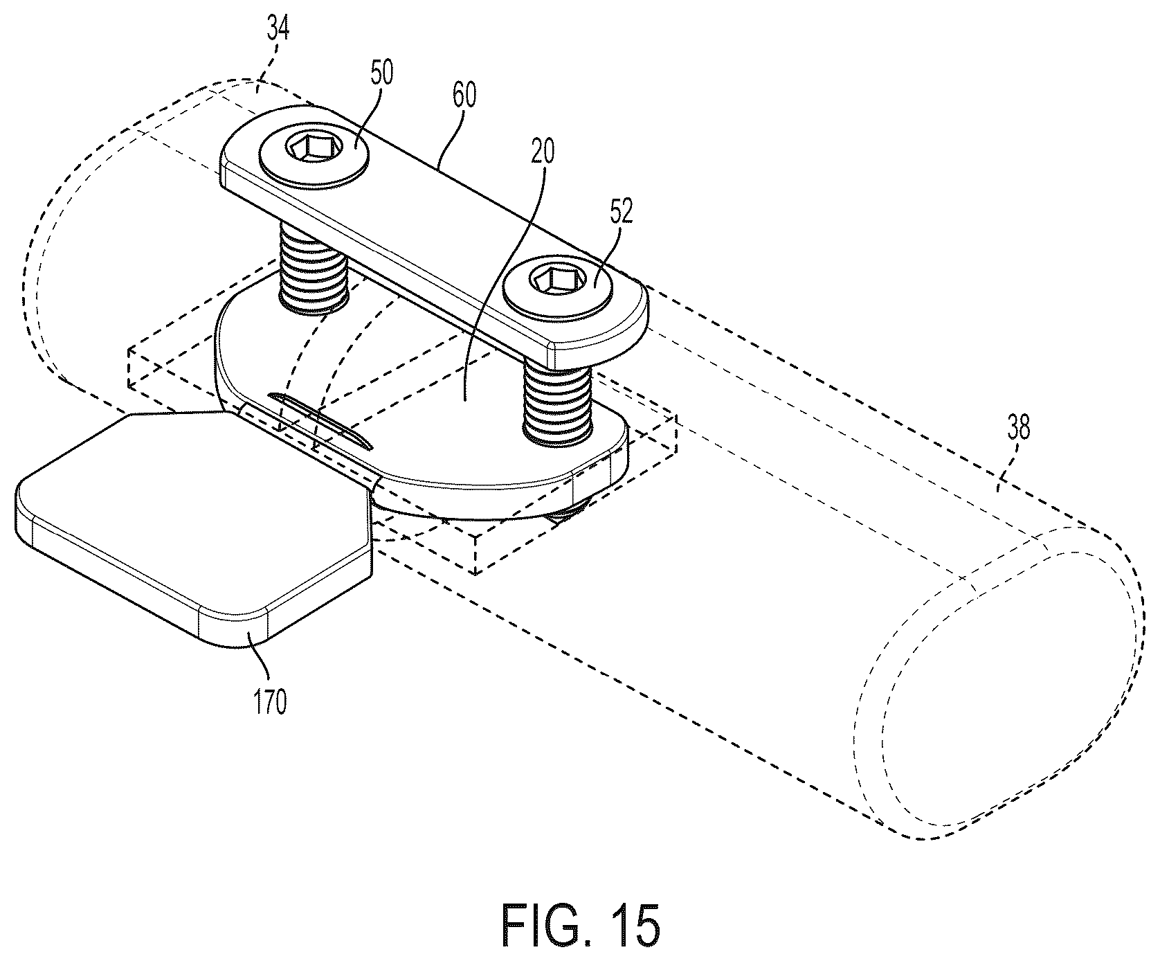 Patent US12396771 Figure 12 – Intra-osseous plate system and method