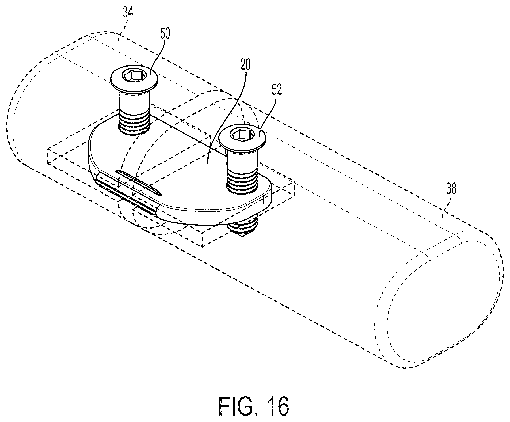 Patent US12396771 Figure 13 – Intra-osseous plate system and method
