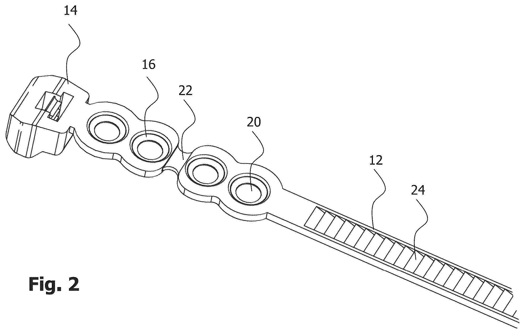 Patent US12396772 Figure 2 – Implant for bone fixation