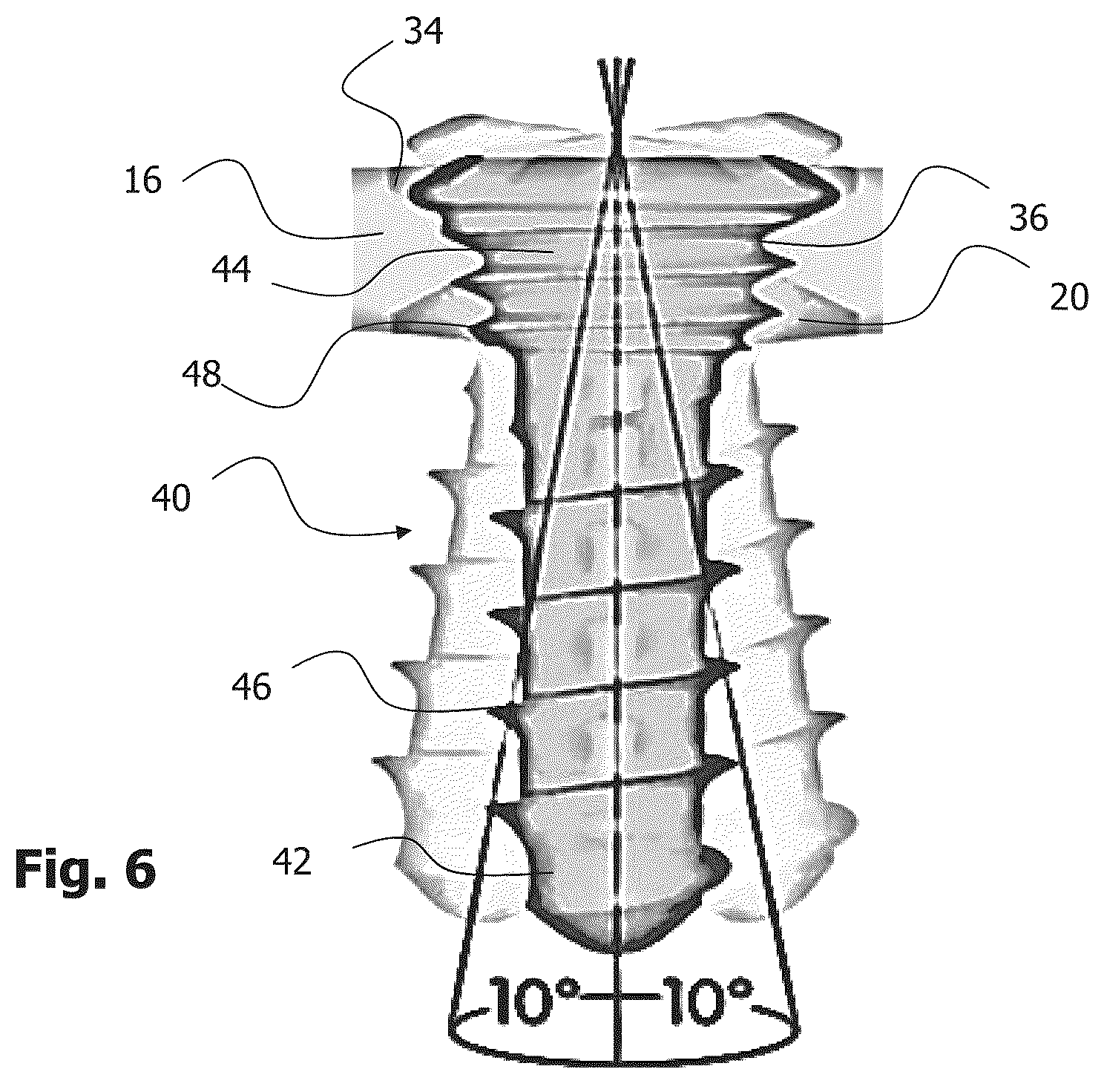 Patent US12396772 Figure 6 – Implant for bone fixation