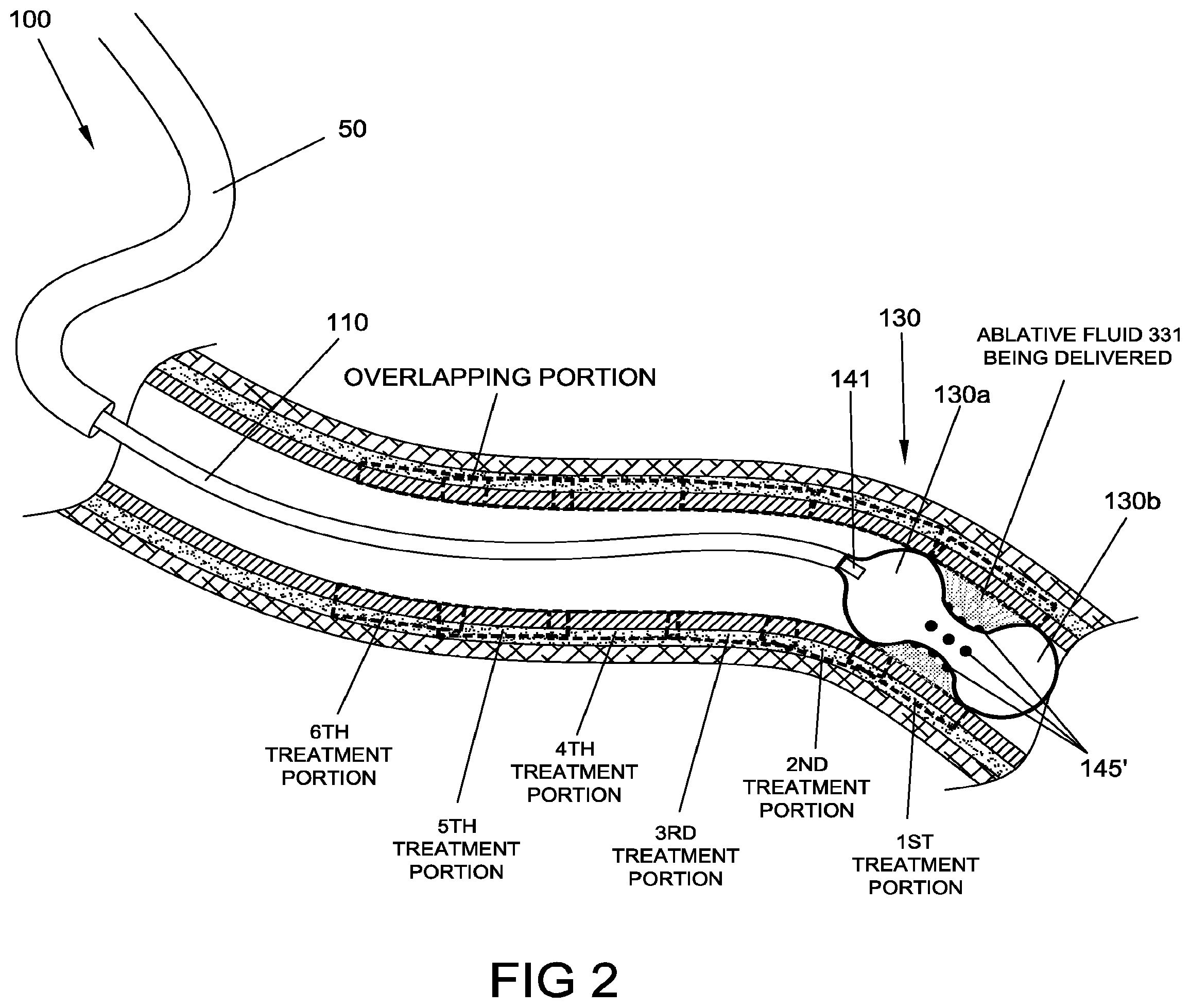 Patent US12396777 Figure 2 – Ablation systems, devices and methods for the treatment of tissue