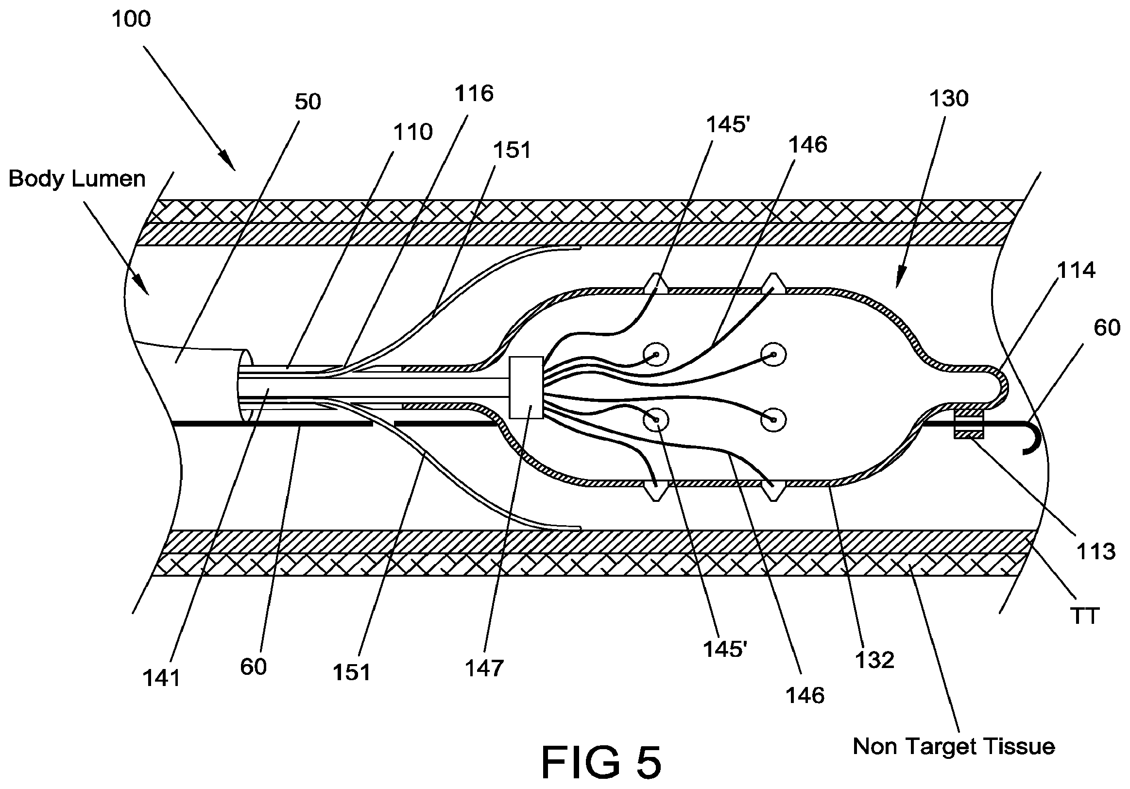 Patent US12396777 Figure 5 – Ablation systems, devices and methods for the treatment of tissue